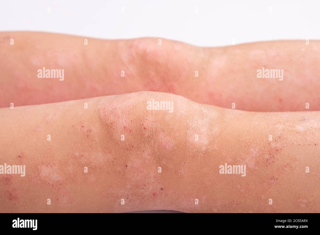 manifestation of dermatitis on the child's body, rash on the legs close-up, redness on the skin, allergic reaction. Stock Photo