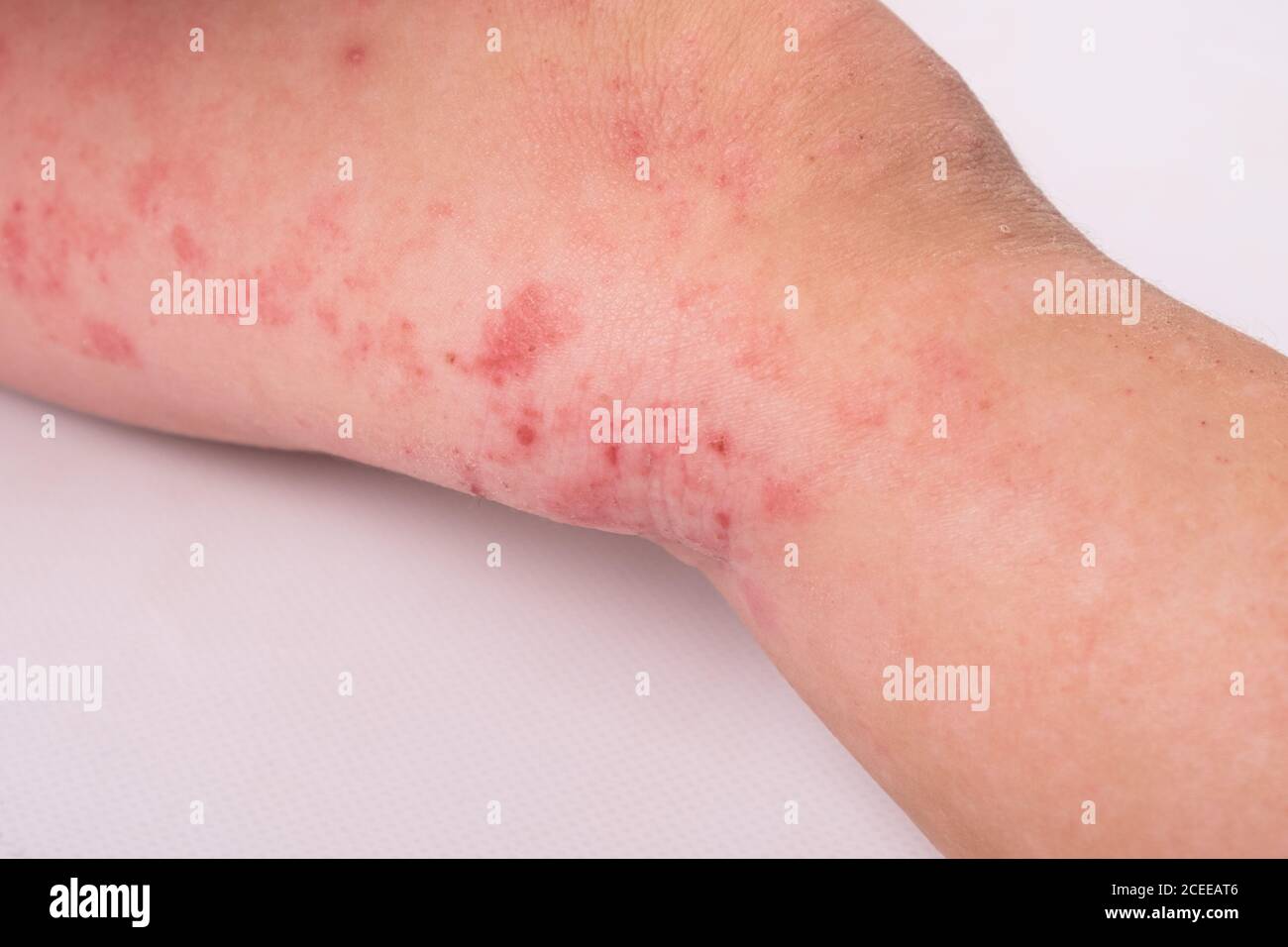 rash on a child's leg isolated on white background, redness, allergic reaction, dermatitis symptom. Stock Photo