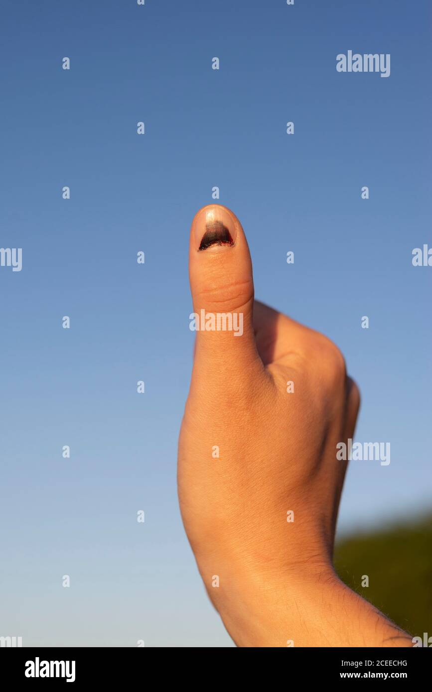 bruised thumbnail. Against the background of the blue sky. Stock Photo
