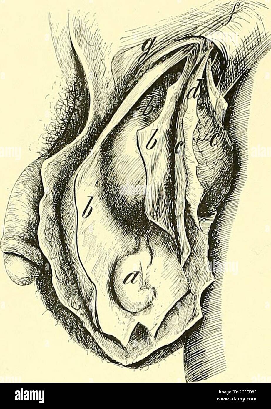 . The anatomy and surgical treatment of hernia. abdominal ring. , -„ i- r „ *- * b. Poupart s ligament. /, /. Intestine. t . 1 ur i a .- ^ a --^ c,c. Internal oblique muscle and its tendon. Figure 2, d. Transversalis passing over the hernial sac. a. Strangulated intestine, the sac cut open. ? fascia passing up to the transversalis. b. The adhesions of the tunica vaginalis to the f- Hernial sac below the abdominal ring,mouth of the sac S- The sac passing under the transversalis into the abdomen.?Tigute J. j^ Dotted lines marking the direction of the Hernia congenita. epigastric artery as it run Stock Photo