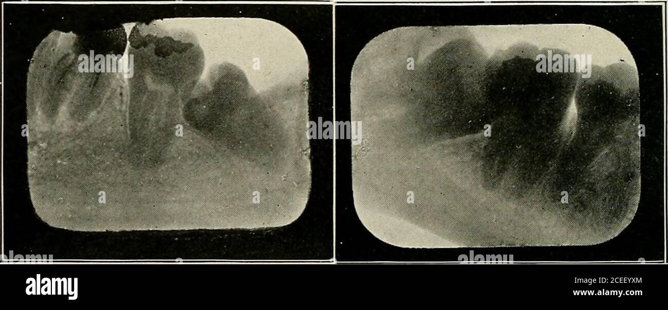 . Oral anaesthesia; local anaesthesia in the oral cavity, technique and