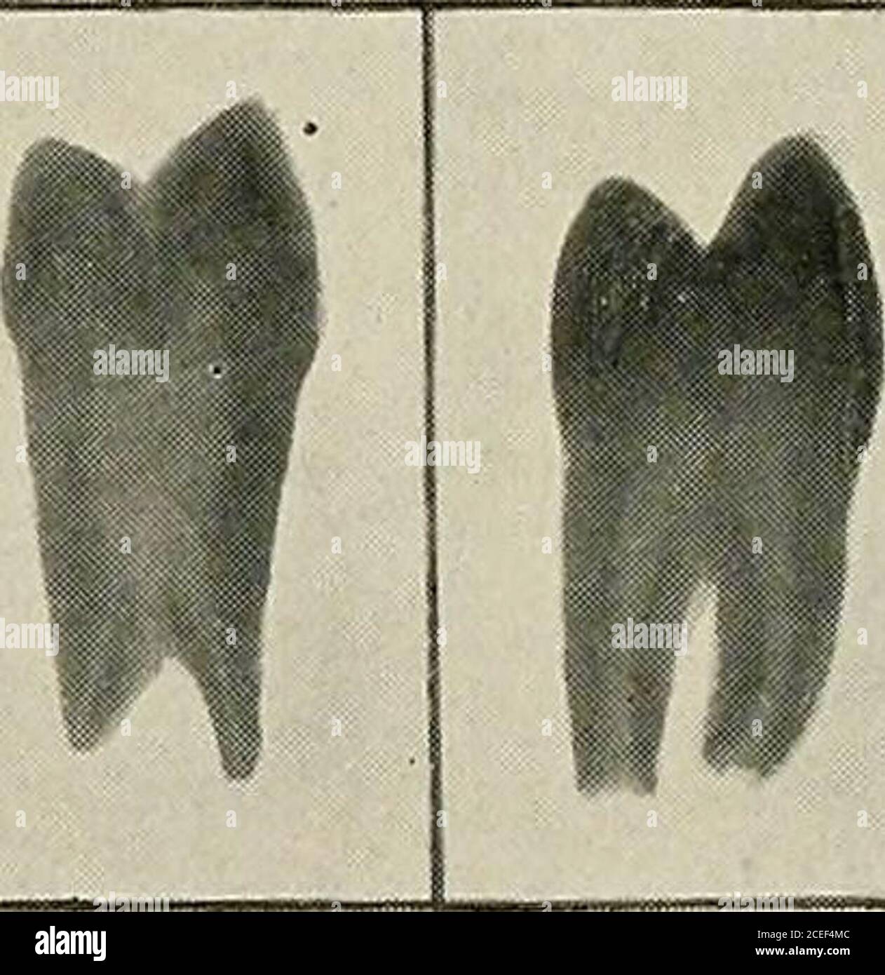 . Oral anaesthesia; local anaesthesia in the oral cavity, technique and