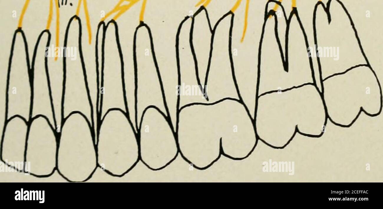 Oral Anaesthesia Local Anaesthesia In The Oral Cavity Technique And Practical Application In The Different Branches Of Dentistry Co 1 Y R Y Fig 19 Schematic Drawing Of The Nervus Maxillaris V Ganglion