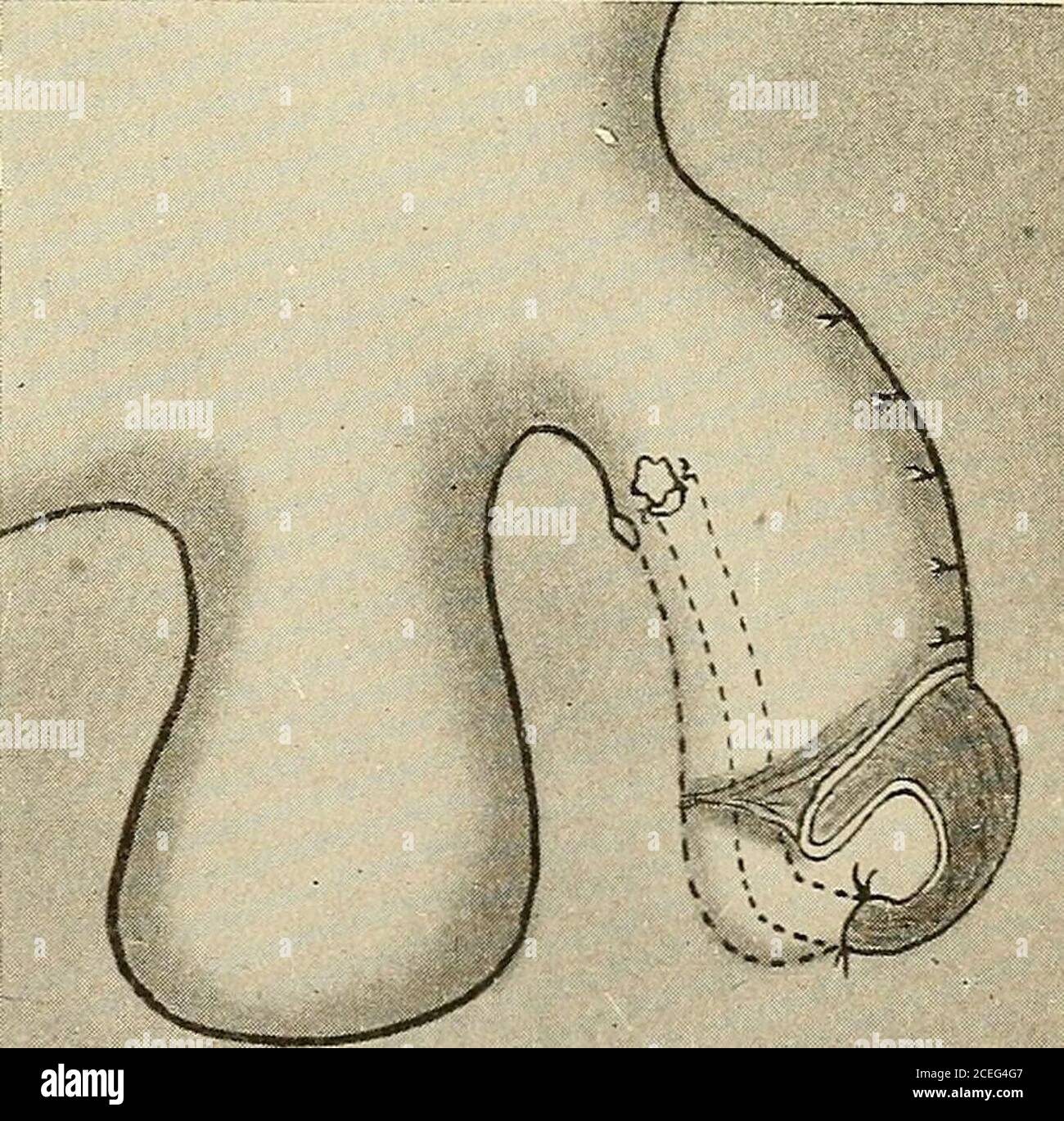 Hypospadias High Resolution Stock Photography And Images Alamy Hypospadias High Resolution Stock Photography And Images Alamy
