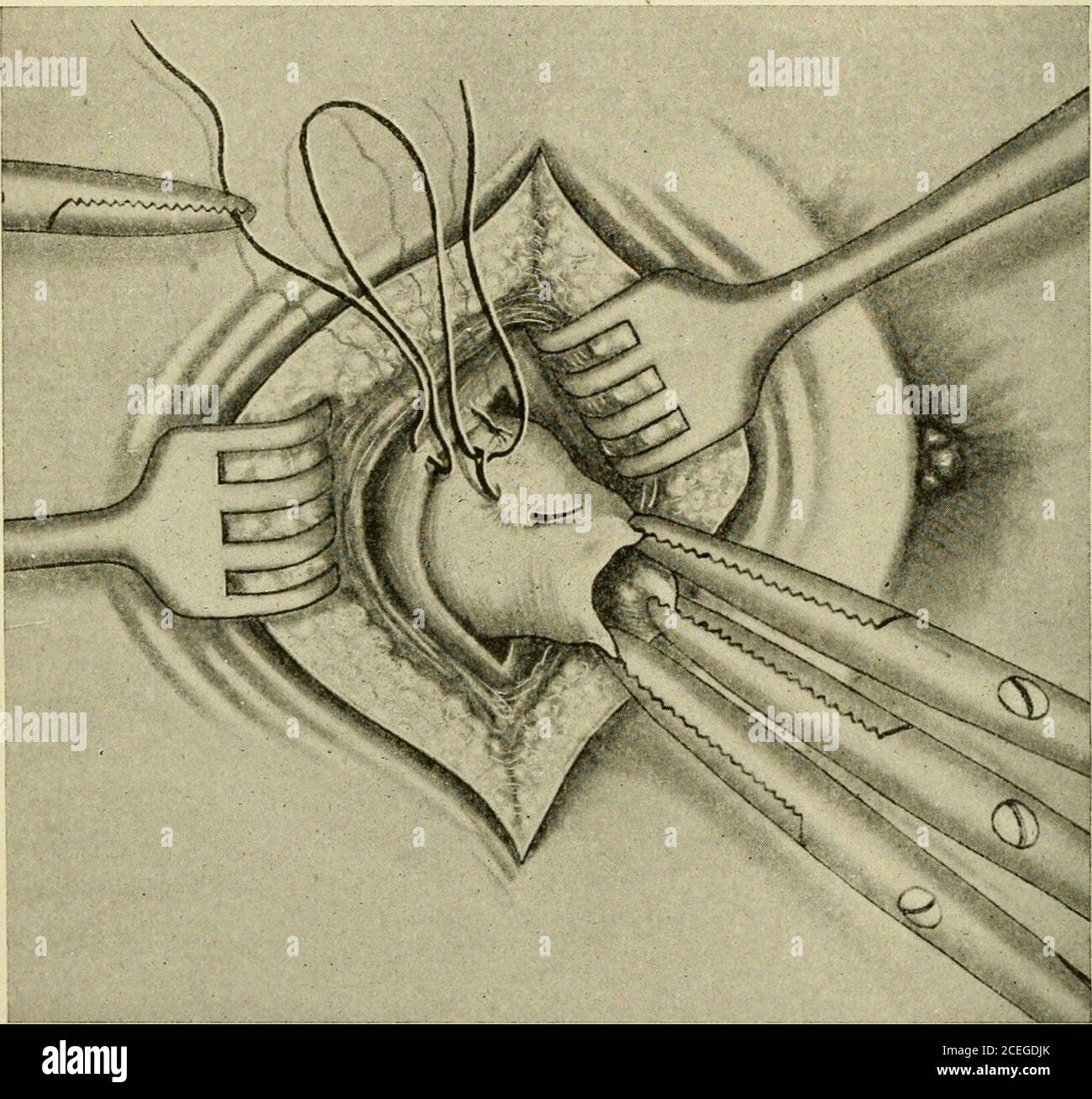 A new manual of surgery, civil and military. ^ satisfactory con-sist in  substituting for the gauze tampon in the gall bladder, a simple rubbertube,  or a split rubber tube filled with
