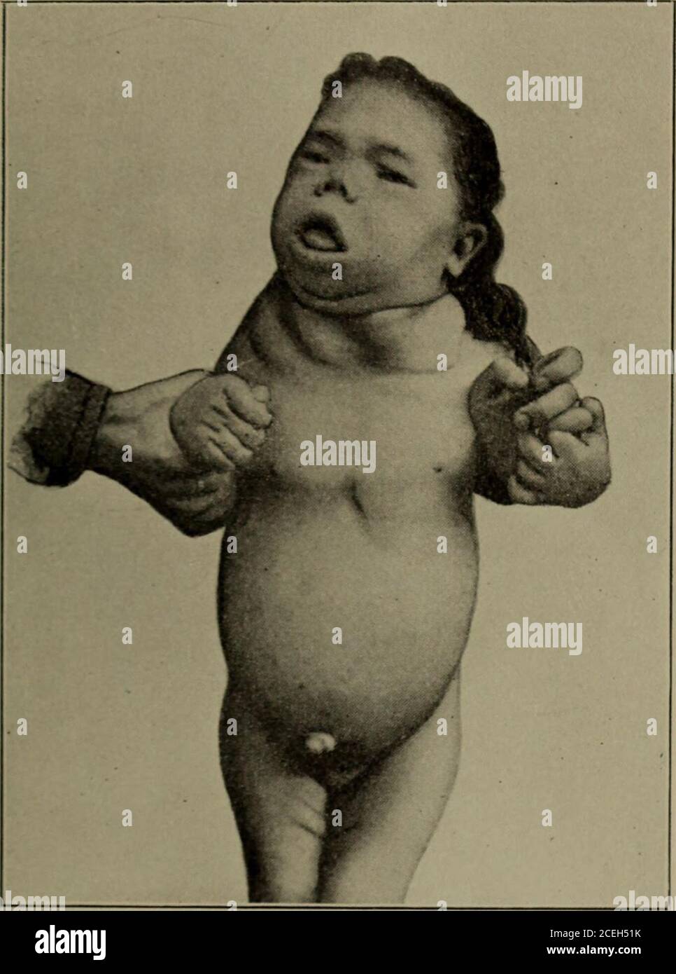 . Medical diseases of infancy and childhood. see page 3). b, The same patient fourmonths later, showing some improvement in the intelligence of her expression—there had alsobeen some increase in height—after treatment by thyroid extract. tongue is large, and may be so much hypertrophied (macroglossia)that it cannot be withdrawn between the lips ; the body is clumsy ;the hands are broad and fin-like; the feet large and flat; the skinis dry and harsh; the hair thin and lustreless. Above and im-mediately below the clavicles there are, in many cases, masses ofsubcutaneous fat. The gait is clumsy, Stock Photo