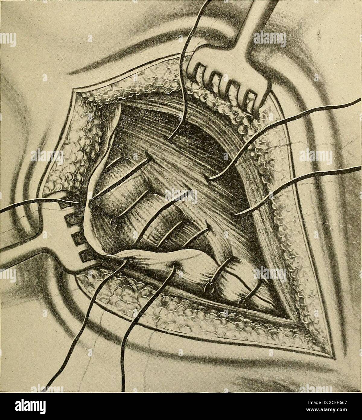 . A new manual of surgery, civil and military. Ferguson s Operation for