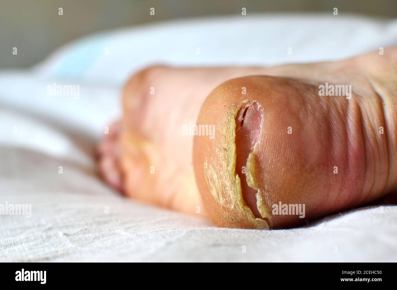 Cracked callus on big toe clearance