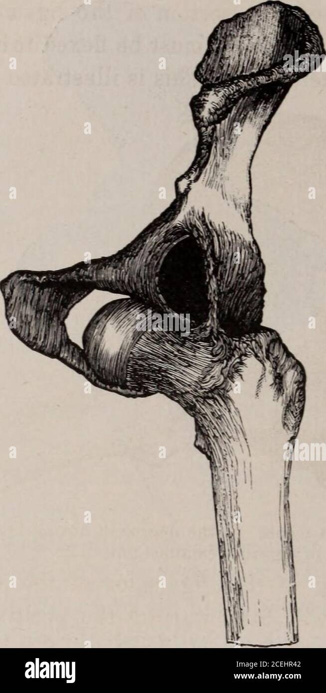 . Chicago medical journal and examiner. of the ligament, and allow an easy transit of the head overthe edge of the acetabulum. Perhaps the most practical method of applying to this form ofdislocation the principles which I have advocated, will be foundin placing the patient on the floor on his back, in the same posi-tion recommended in the dorsal luxation. An assistant fixesthe pelvis while the surgeon flexes the thigh at a right angle withthe trunk, and the leg upon the thigh ; he then adducts, rotatesinwardly, and draws the limb forwards in the direction of ex-treme adduction, thus lifting t Stock Photo