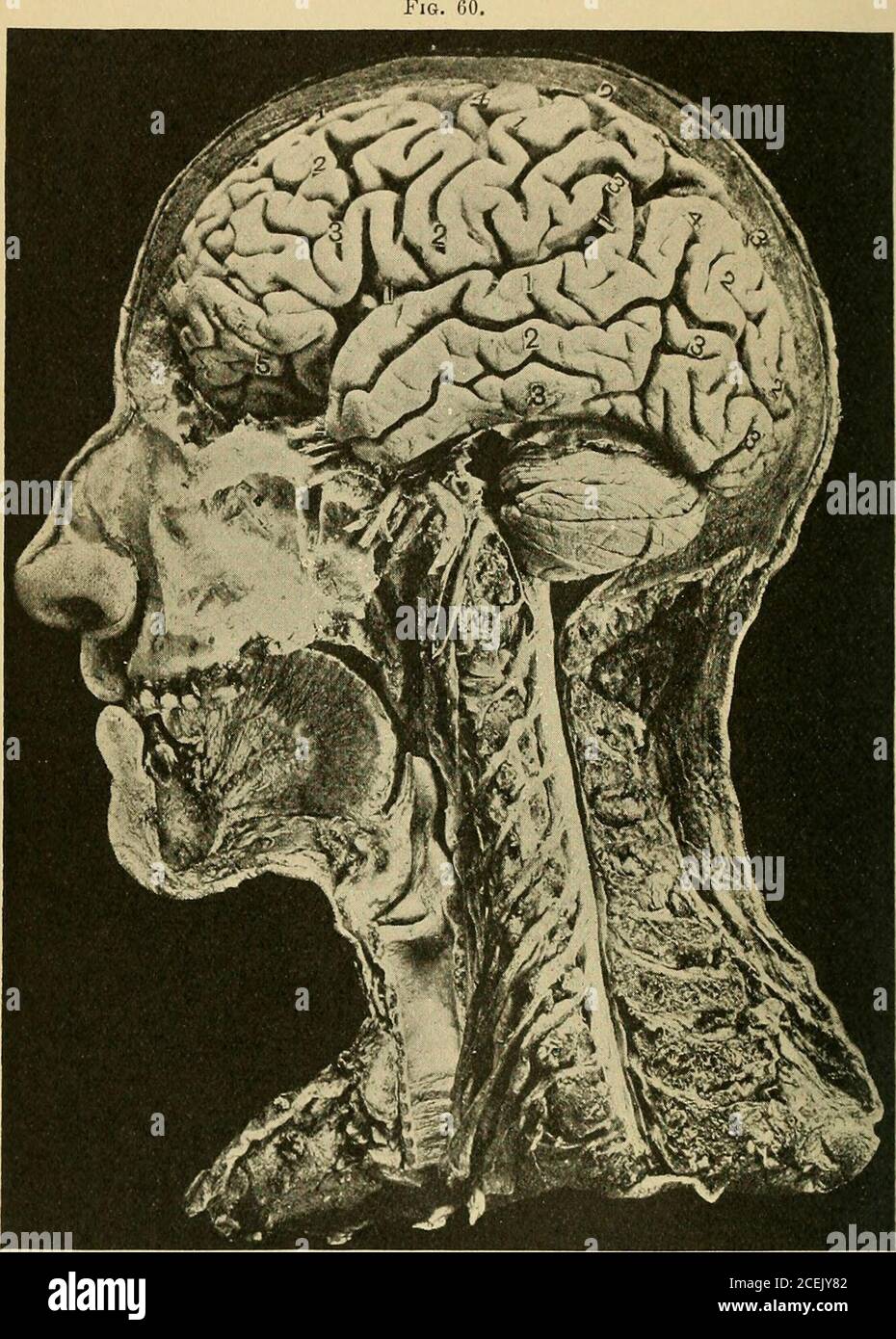 . A treatise on nervous and mental diseases, for students and practitioners of medicine. Photograph from Fraser, showing the cerebrum and the cerebellum in the cavity ofthe skull covered by the membranes; also the upper portion of the spinal cord. I. The longitudinal fissure corresponds with the median line ofthe vertex from the glabella, or junction of the nasal and frontalbones, to the inion, or occipital protuberance. II. To find tlie fi.ssure of Rolando: Measure the distance fromthe glabella to the inion, or occipital protuberance. Find 55.7 80 INTRODUCTORY. per cent, of this distance, and Stock Photo