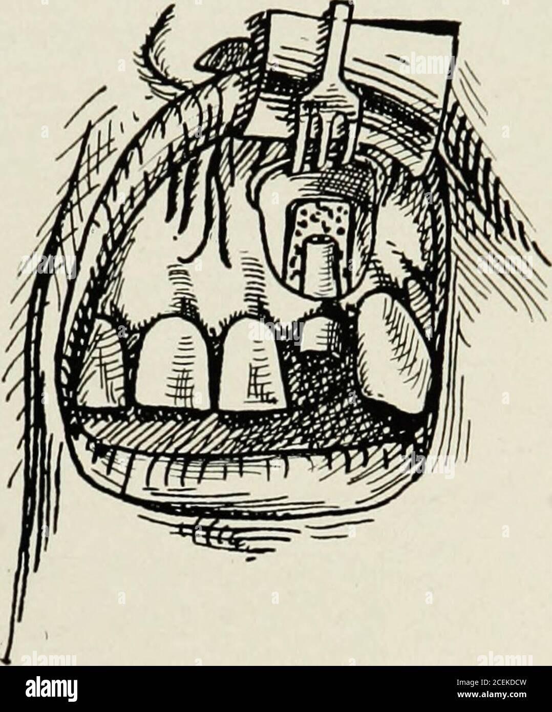 . Oral anaesthesia; local anaesthesia in the oral cavity, technique and