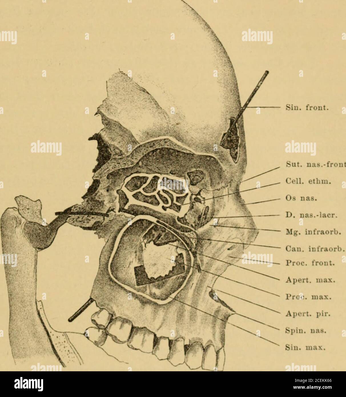 Handbuch Der Laryngologie Und Rhinologie Dianebene Liegen Bei Erhaltener Stirnnaht In Der Fortsetzung Derselben Es Kommen Aber Auch Abweichende Falle Vor Die Internasalnahtkann Im Ganzen Nach Der Einen Oder Anderen Seite