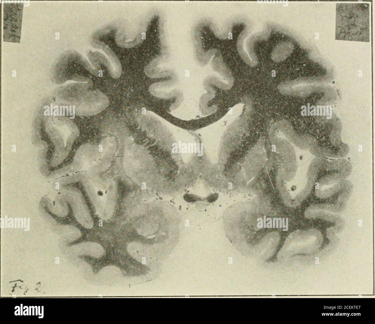 . The Journal of nervous and mental disease. erves. Rsmaller than left. rht putamen slightly remarkable changes in the liver with disease of the lenticular nucleusit should be emphasized, perhaps, that no other affection was foundin the piece of liver than the foci of lymphocytes. The pia mater could be stripped from the brain without difficulty.ictionthrough the brain in the coronal plane, passing throughthe lenticular nuclei, disclosed a marked difference in size betweenthem, the right appearing much shrunken. Large block- of tissue were kept in bichromate of potassium forral months; this ne Stock Photo