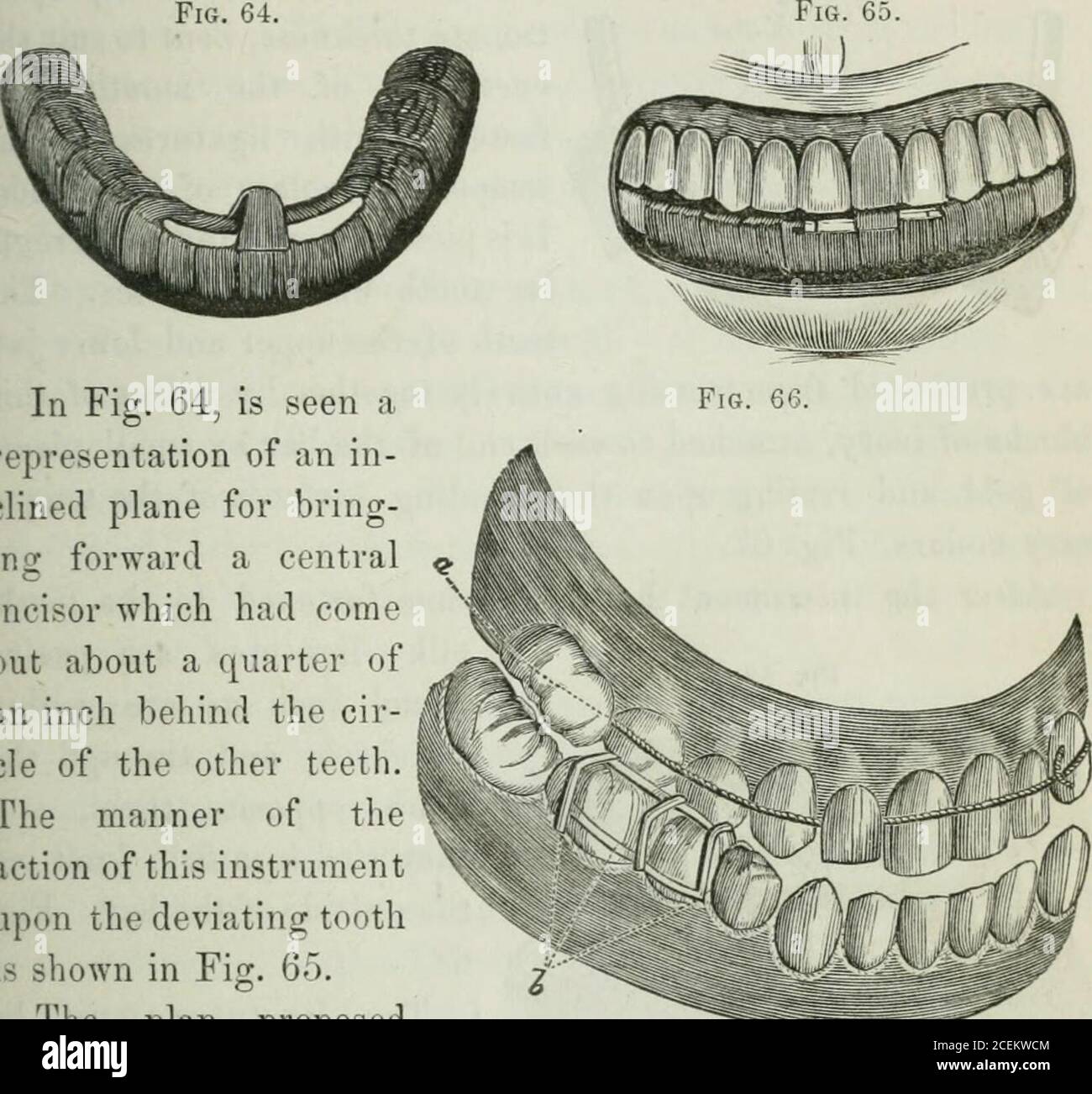 . The principles and practice of dental surgery. TREATMENT OF IRREGULARITY OF THE TEETH. 15 encasing them and the alveohir ridge. An encasement of thissort (Fig. 64), possesses greater stability than can he obtainedfor an appliance like the one represented in Figs. 62 and 63. Fig. 64.. In Fig. 64, is seen arepresentation of an in-clined plane for bring-ing forward a centralincisor which had comeout about a quarter ofan inch behind the cir-cle of the other teeth.The manner of theaction of this instrumentupon the deviating toothis shown in Fig. 65. The plan proposedby Delabarre, as shown in Fig. Stock Photo