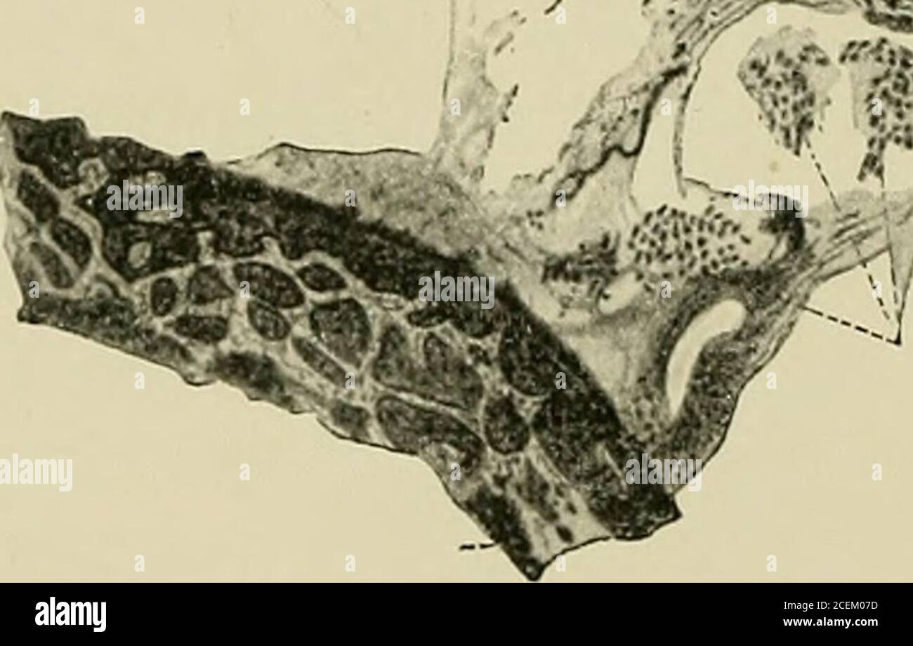 . The bacteriology of the eye. 4. #■ Fig. 70.—Uhthoff and Axenfeld, Keratomycosis Aspergillixa.Vegetable foreign body with mycelium. sible, as no spore formation was obtained (Oospora ascoform ! Verti-cillium rubrum ?). Halbertsma also found that the Aspergillus flarescens was patho-genic for the cornea of the rabbit. Aspergillus niger, A. Jicuum,A. wentii, and to a very slight extent the A. candidus, have beendescribed as having a moderate degree of pathogenicity for the corneaof the rabbit, and to a certain extent also for the vitreous and thechoroid. A. glaucus, ostianus, minimus, clavatus, Stock Photo