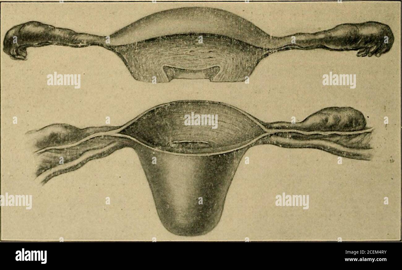 Pelvic inflammation in women Fig 59 Freeing the Tube from its