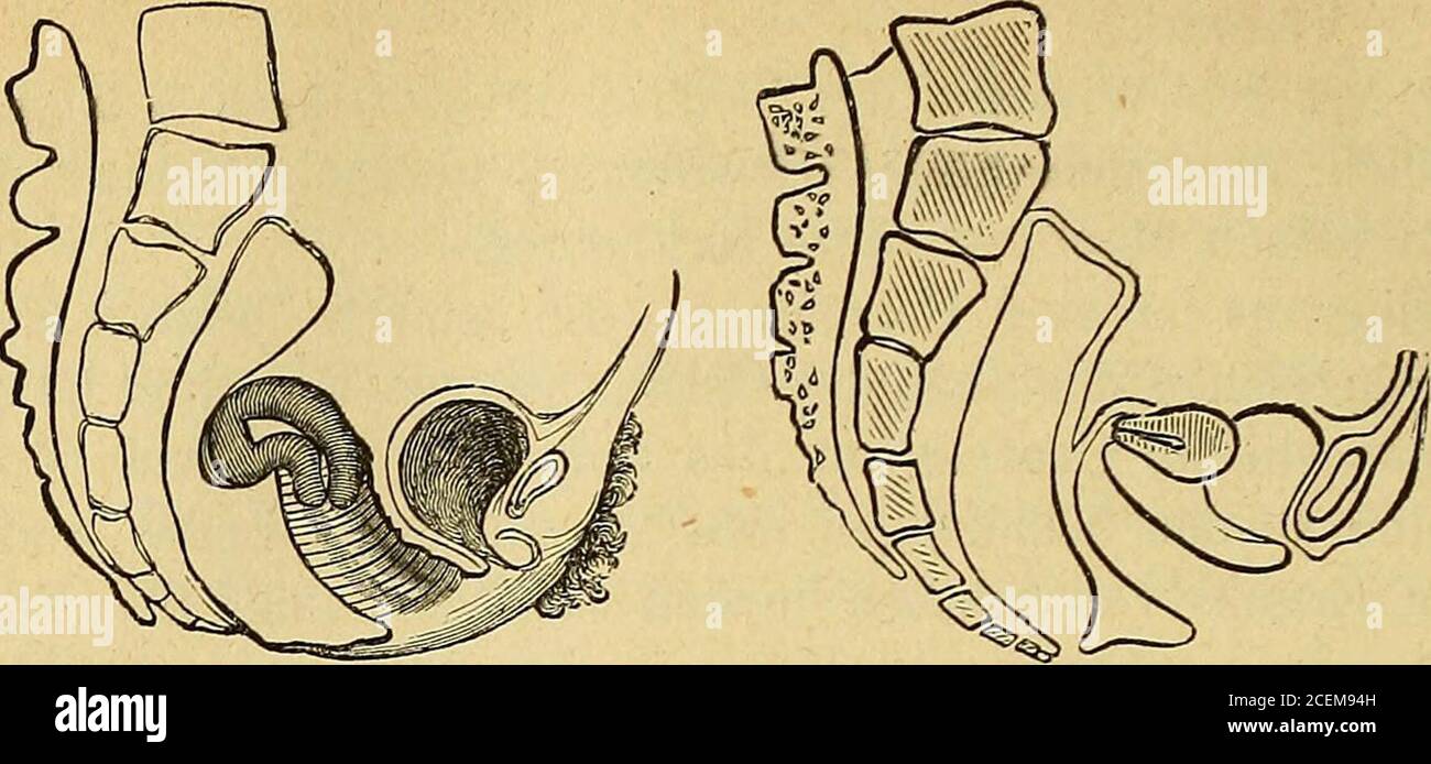 . Lehrbuch der Frauenkrankheiten. Conischcr Cervix (Sims). welche man meistens 510 Sterilität.Fig. 200. Fig. 201.. Beugung als Ursache derUnfruchtbarkeit. Neigung als Ursache derUnfruchtbarkeit. Krankheit nicht unterschätzen. Das zweite Stadium derselben bestehtbekanntlich in einem Erguss von Lymphe, welche sich mit der Zeitretrahirt und diese Kanäle entweder zusammenschnürt oder an einerabnormen Stelle fixirt. Bei der Dysmenorrhoea membranacea wird wegen der damit ver-bundenen periodischen Exfoliation der Uterusschleimhaut die Innen-fläche der Gebärmutter zur Aufnahme und Einbettung des Ovulu Stock Photo