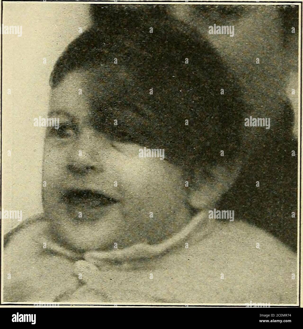 Diseases Of Children F The Child Should Be Built Up The Nervous System Quieted And Anyassociated Disease Treated Tonics Containing Cod Liver Oil Strychnin And Iron Should Be Administered Salt Water Bathing Is Very