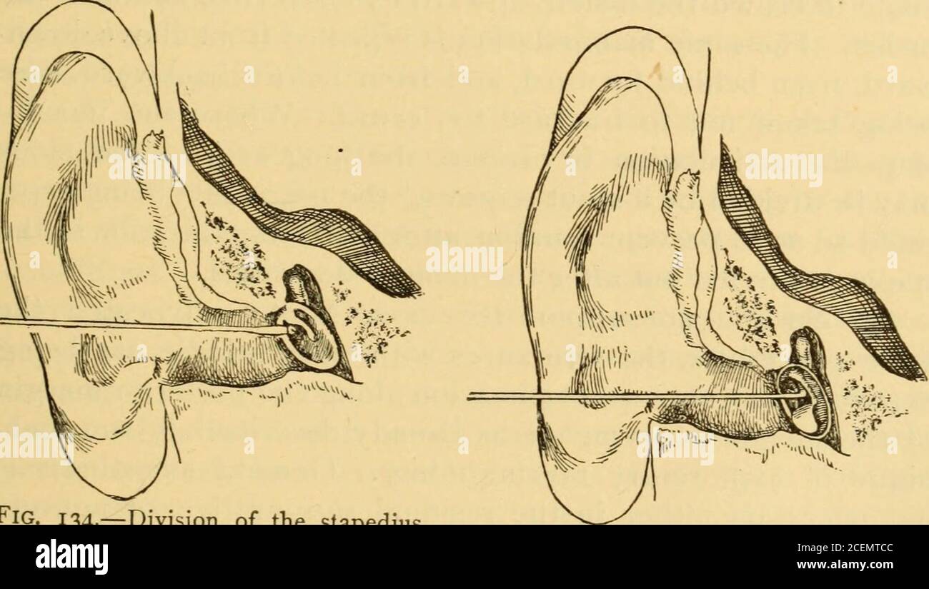 Stapedius muscle hi-res stock photography and images - Alamy