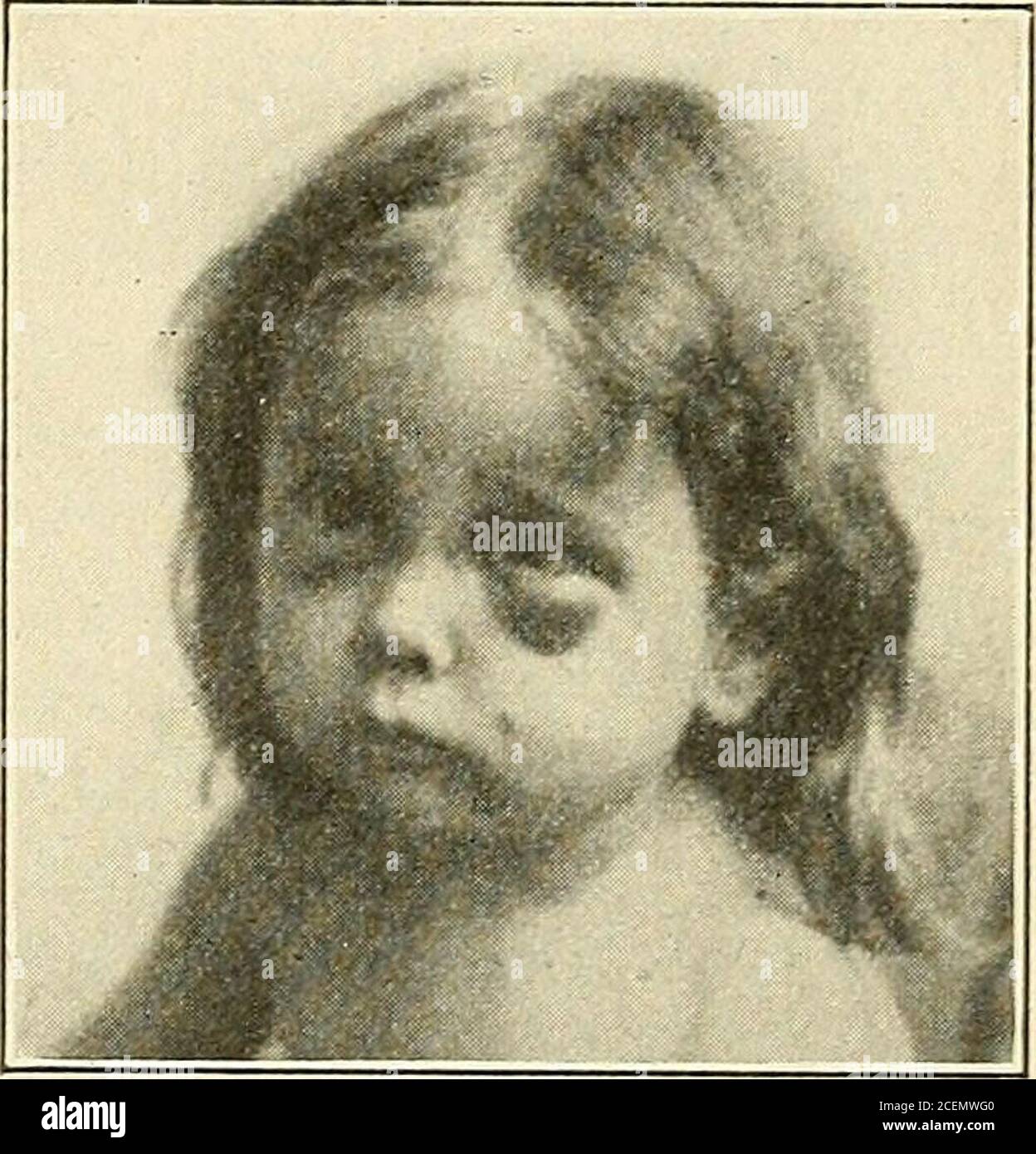 . Diseases of children. e diagnosis is based upon the presence of purpurichemorrhages from the skin and mucous membranes, and severe consti-tutional symptoms which may or may not indicate visceral hemorrhage.Joint pains are not marked, if present at all, and this, with the absenceof urticaria, excludes the rheumatic t^-pe. A possible hemophiliacphase is eliminated by the lack of a family history characteristic ofthe bleeder and the freedom from previous hemorrhage. Abdominalcrises of Henochs purpura do not occur. Prognosis.—If the case be mild a favorable prognosis may be givenguardedly. The w Stock Photo