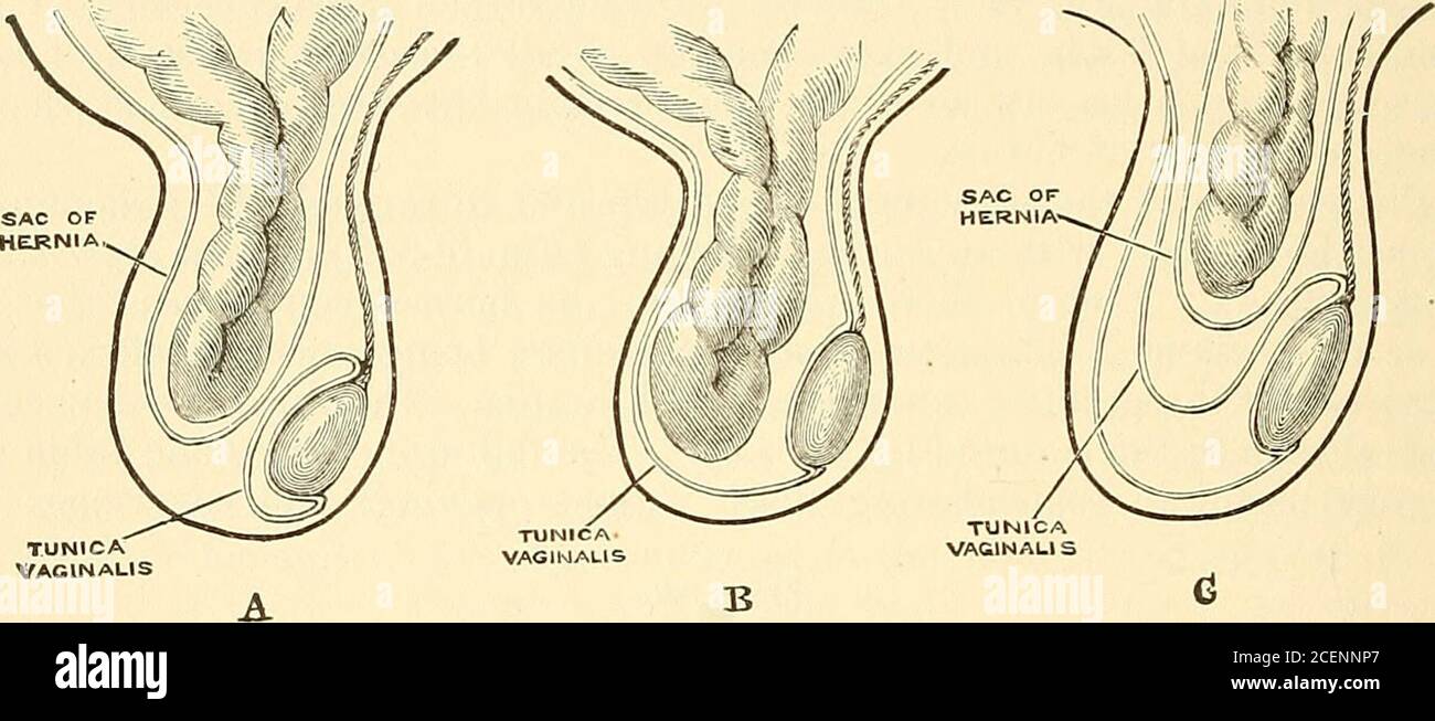 . Anatomy, descriptive and surgical. ia. Saphenous opening closed by theCribriform fascia. ] INGUINAL HERNIA. Inguinal Hernia is that form of protrusion which makes its way through theabdomen in the inguinal region. There are two principal varieties of inguinal hernia—external or oblique, andinternal or direct. 998 SURGICAL ANATOMY OF INGUINAL HERNIA, External or oblique inguinal hernia, the more frequent of the two, takes the sameoblique course as the spermatic cord. It is called external, from the neck of the sacbeing on the outer or iliac side of the epigastric artery. Internal or direct iv Stock Photo