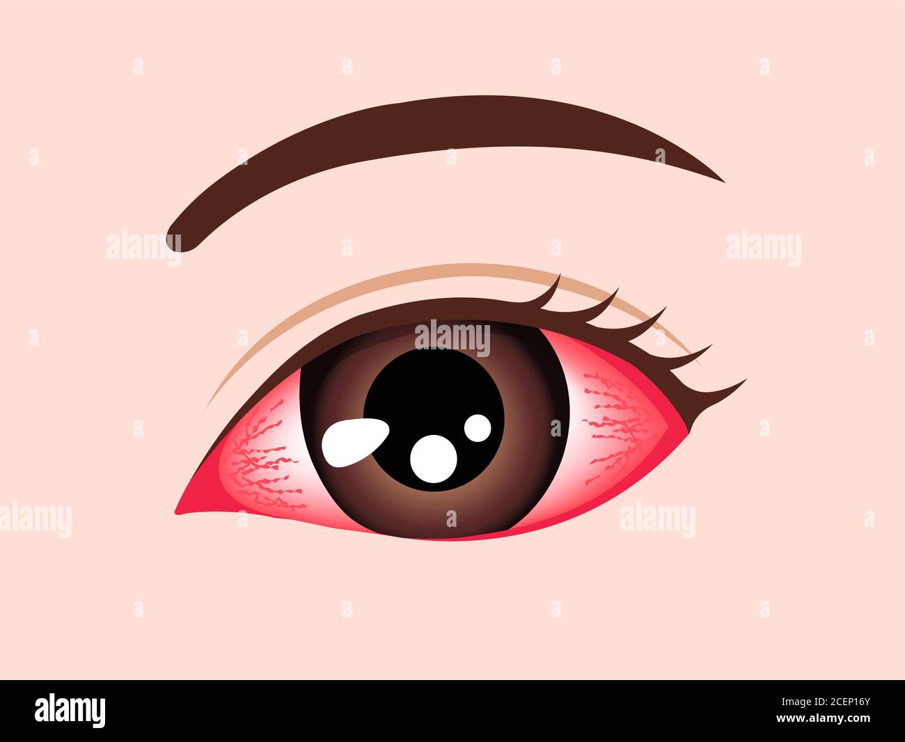 Conjunctivitis (pink eye) vector illustration Stock Vector