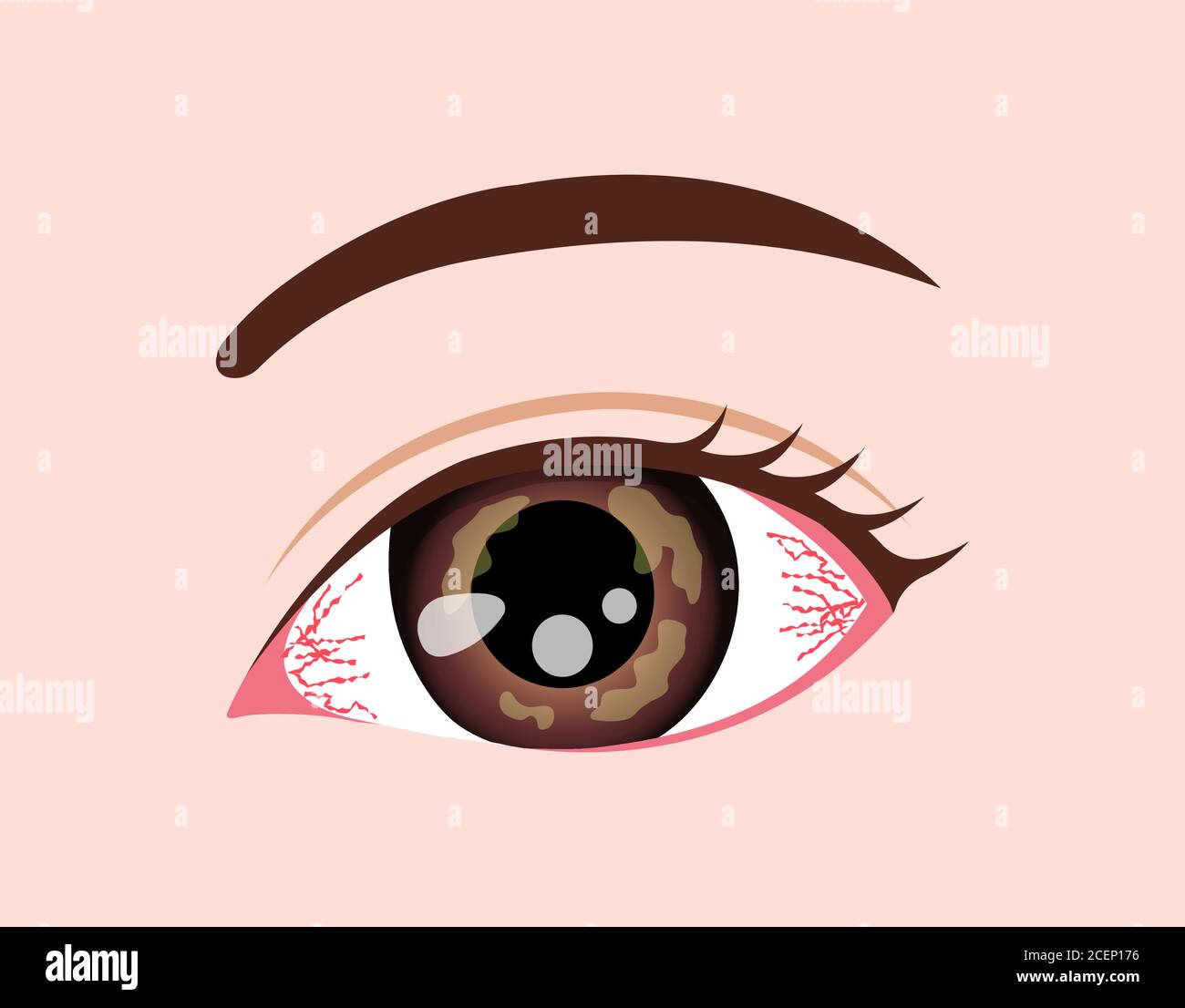 Eye disease vector illustration / Herpetic keratitis Stock Vector