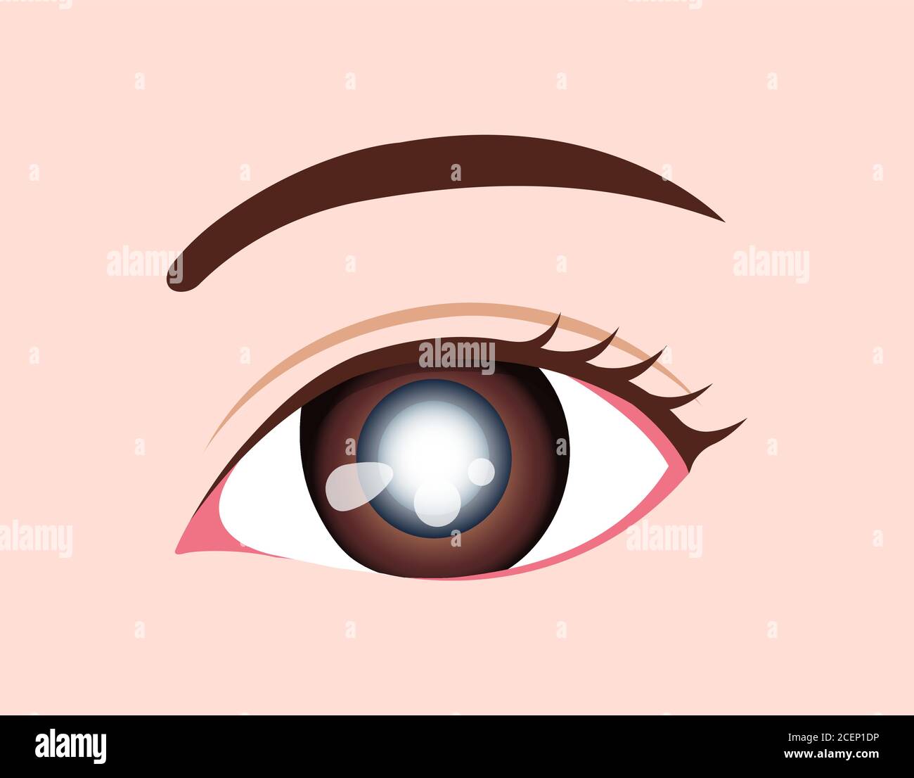 Eye disease vector illustration / Cataract Stock Vector