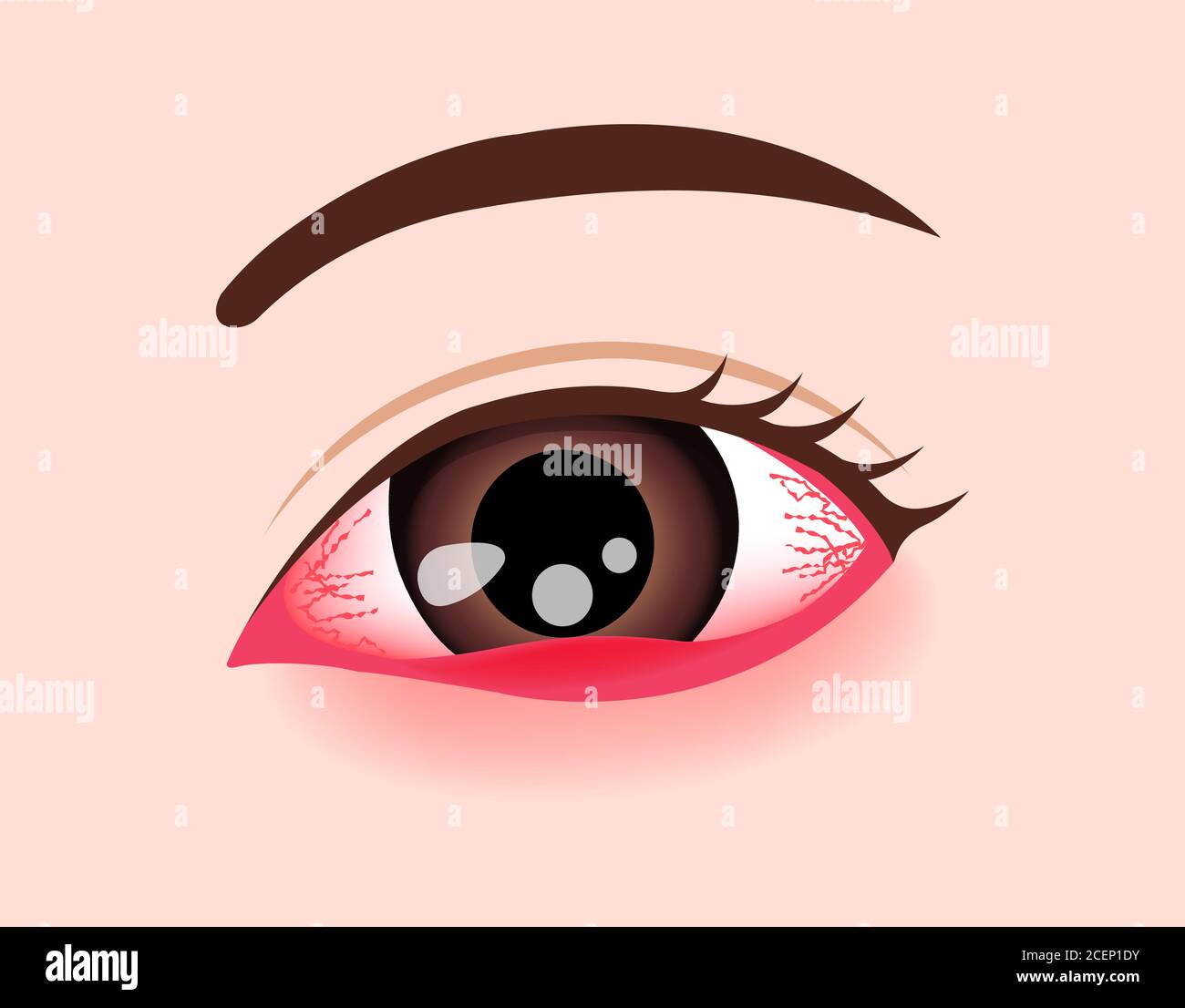 Eye disease vector illustration / Stye, Hordeolum Stock Vector