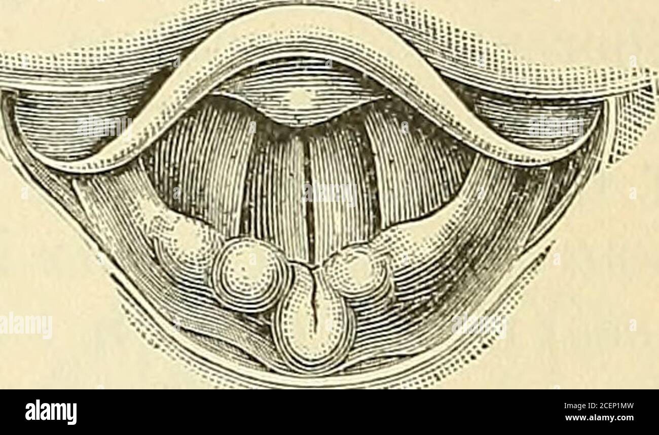 . Anatomy, descriptive and surgical. [Fig. 610.. Laryngeal Image during ...
