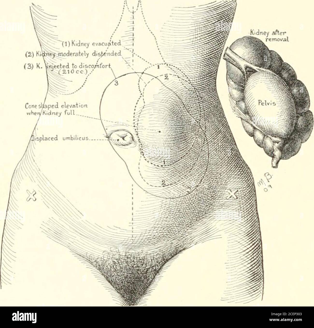 Diseases of the kidneys, ureters and bladder, with special reference to the  diseases of women. 255,where a cyst developing inthe sinus renalis has  pressedupon the ureter and producedhydronephrosis. A similarcase, in