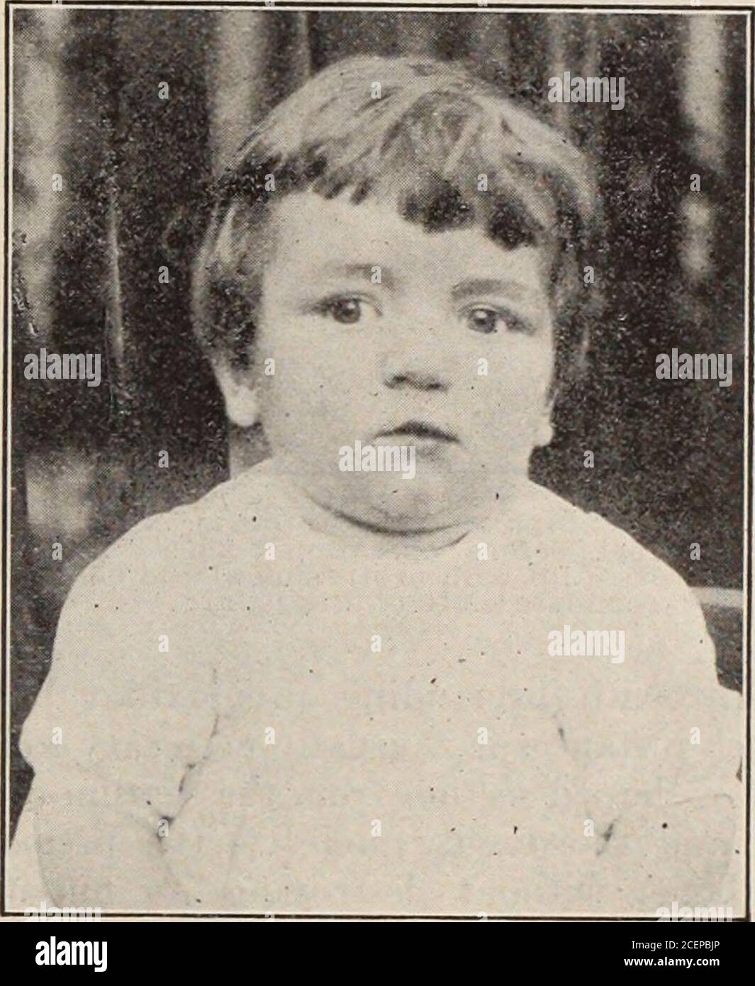 Cleft lip baby hi-res stock photography and images - Alamy