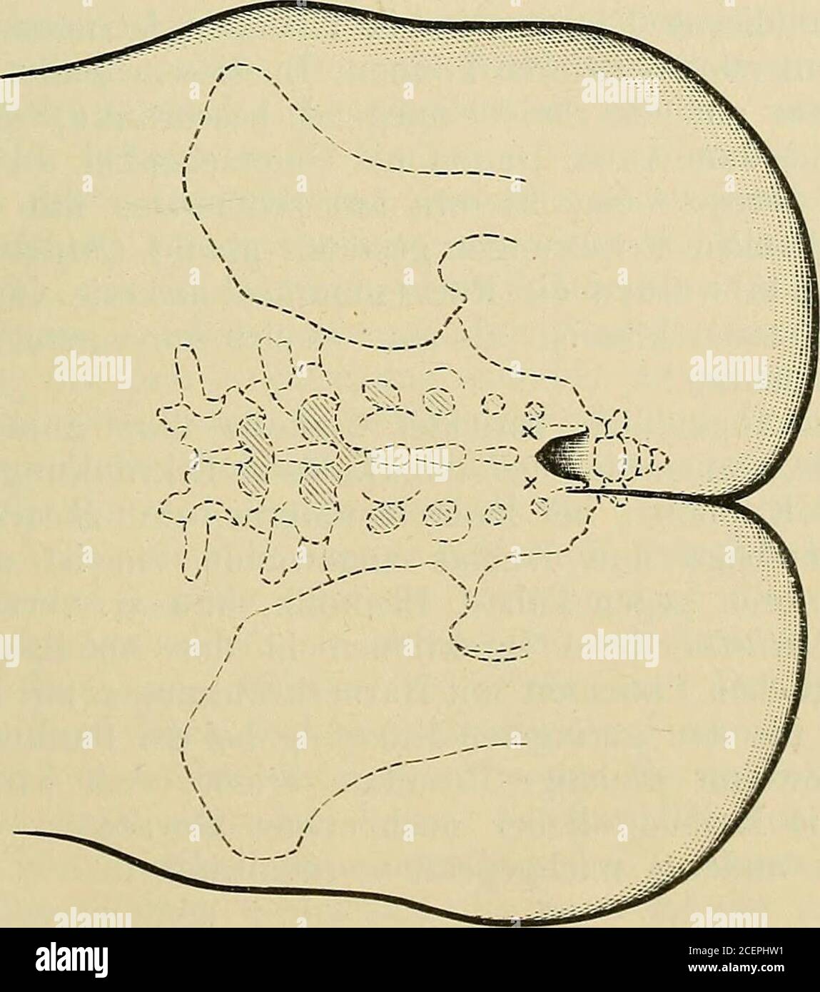 . Handbuch der allgemeinen und lokalen Anaesthesie für Ärzte und Studierende. vorsprünge fühlt, die einen nur irreführen können (Fig. 92). Im allge-meinen kann man sagen, daß man die Neigung hat, zu tief unten zupunktieren. Man hat auch die Rima natium als Anhaltspunkt benutzt. Dieuntere Öffnung des Sakralkanals liegt allerdings 1—o cm weiter oben.. als die Rima. Dabei ist aber zu beachten, daß in Seitenlage desPatienten die Rima nie mit der Verbindungslinie des Sakralwirbelkanalszusammenfällt. Hier gelten dann die Verhältnisse, wie sie in Fig. 9oabgebildet sind und es ist wichtig, dies zu ber Stock Photo