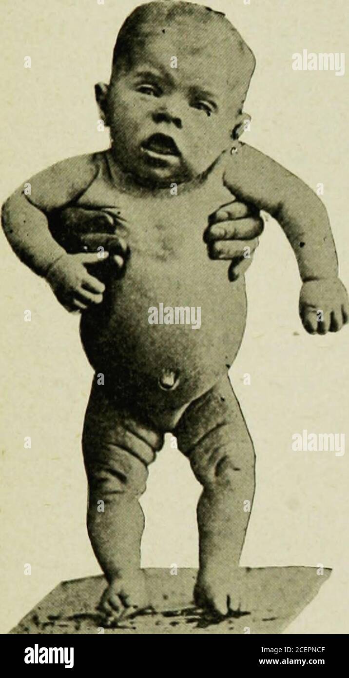 . The diseases of infancy and childhood. protruding tongue, the