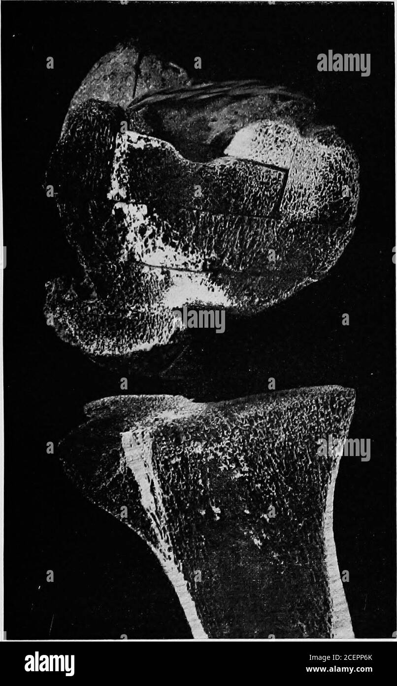 . On boneformation, its relation to tension and pressure;. Fig. 32. Fig. 33 53 a thin layer of the periosteal bone in the periphery hasbeen better preserved, thus maintaining the externalform of tibia and femur. This phenomenon will be dealtwith later (see pp. 96-101). In the present only the transitionof cancellous tissue into compact bone is of interest—a process which we also observed more or less completelyin the ankylosed elbow of Fig. 34 and the ankylosed hip(Fig. 35, cf. Fig. i). It appears to go hand in hand witha reduction of the transverse sections conducting theforces acting upon th Stock Photo