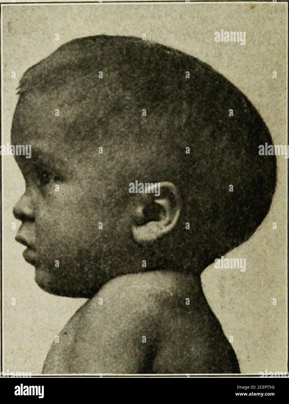 . The diseases of infancy and childhood. Fig. 107.—Oxycephaly with