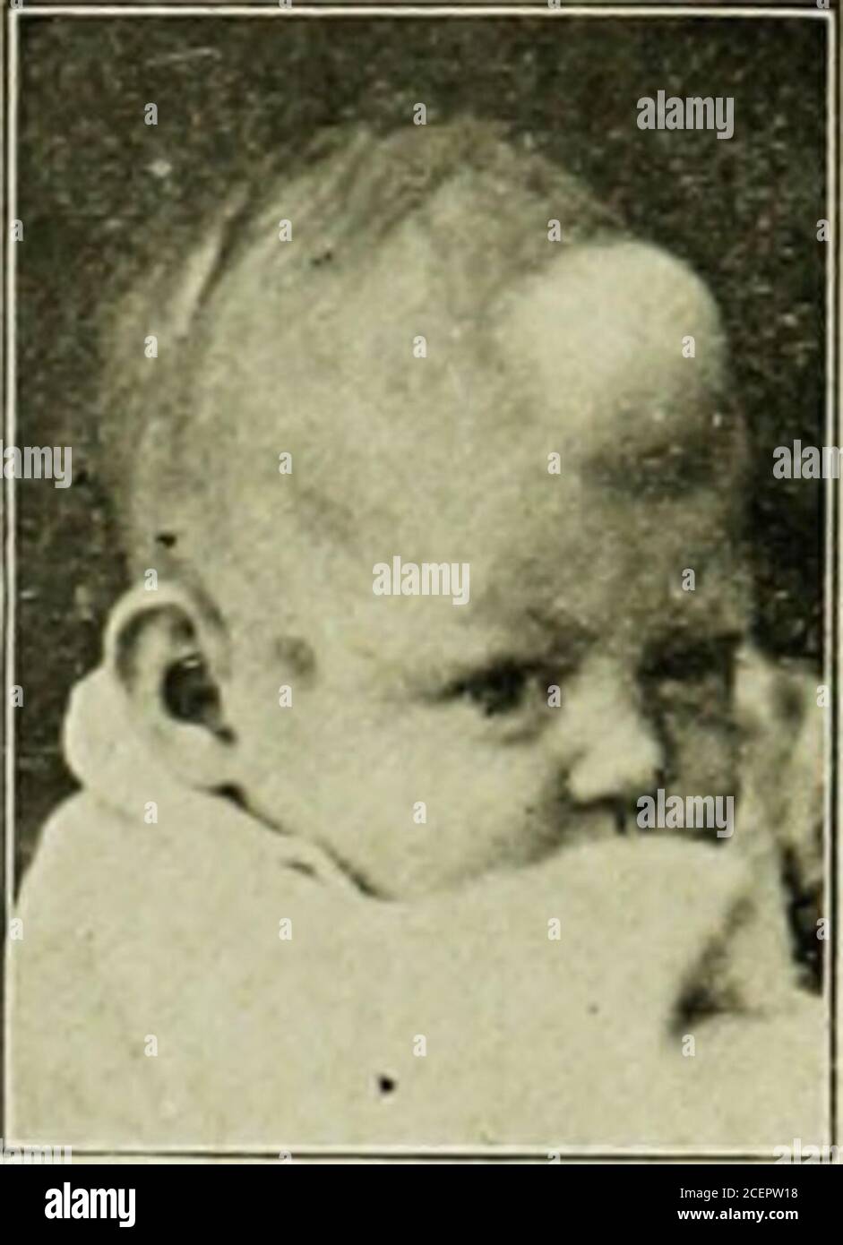 . The diseases of infancy and childhood. Fig. 90.—Meningocele. Infant oneMonth old. MALFORMATIONS 721. Fig. 91.— Frontal Meningocele. Infant Three Months Old. tion of fluid, which communicates by a small opening with the generalarachnoid cavity of the brain. Of 105 cases collected by Schatz, 59 occupied the occipital regionand 46 were frontal. The aperture through which the occipital pro-trusion takes place is usually in the median line. It may communicatewith the posterior fontanel, with the foramen mag-num, or with the cleft of a spina bifida. The occip-ital bone may be divided in the median Stock Photo