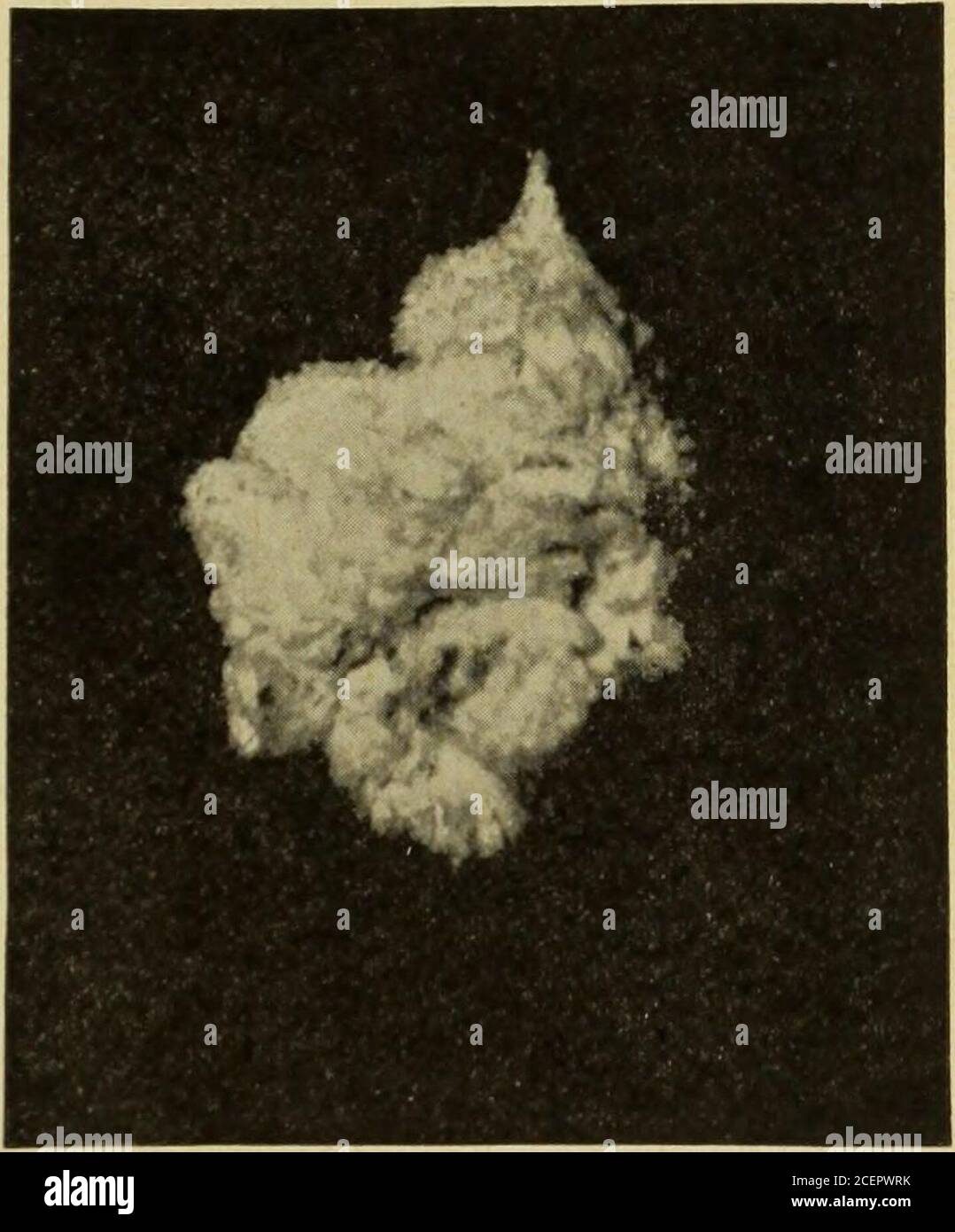 Modern Medicine And Bacteriological Review Ed Sufficiently To Be Able Toresume His Occupation His Physician However Suspected The Existence Of Somemore Serious Disorder Than Ordinary Vesi Cal Catarrh And At His Request I