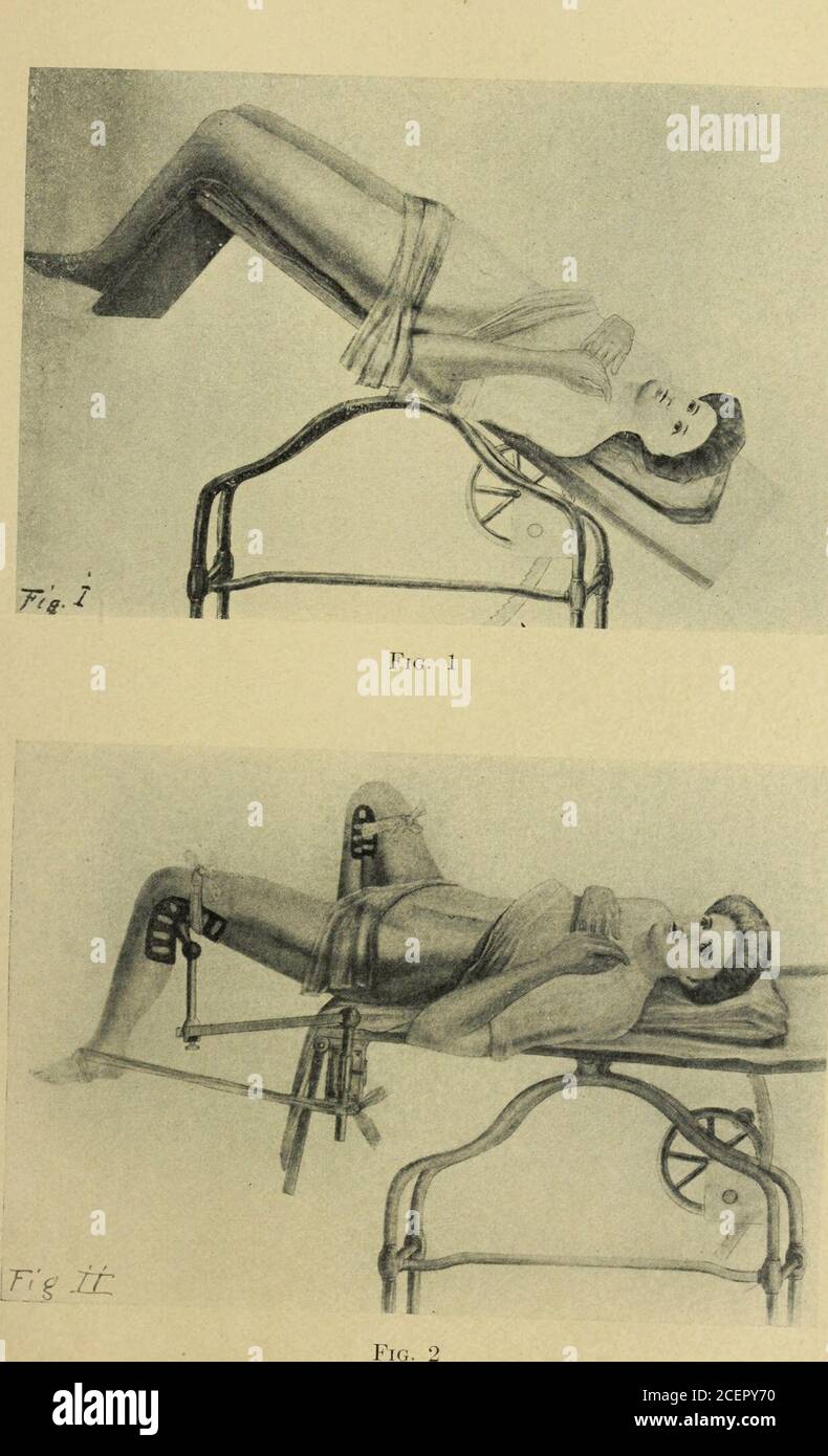 . Transactions of the Southern Surgical and Gynecological Association. ich fits comfortably in the poplitealspace (we use Behrhoffs) one may secure exposure of theabdomen in an elevated position, and, at the same time,exposure of the pelvic outlet, making possible the use ofself-retaining speculums, if desired, and permitting com-bined or multiple operations to be made simultaneouslythrough the abdomen and pelvic outlet (Figs. 2 and 3). Thisis accomplished by having the popliteal knee-holder (Figs.4 and 5) hinged on a short upright bar (c), which is broadenedand slotted at the lower end to sli Stock Photo