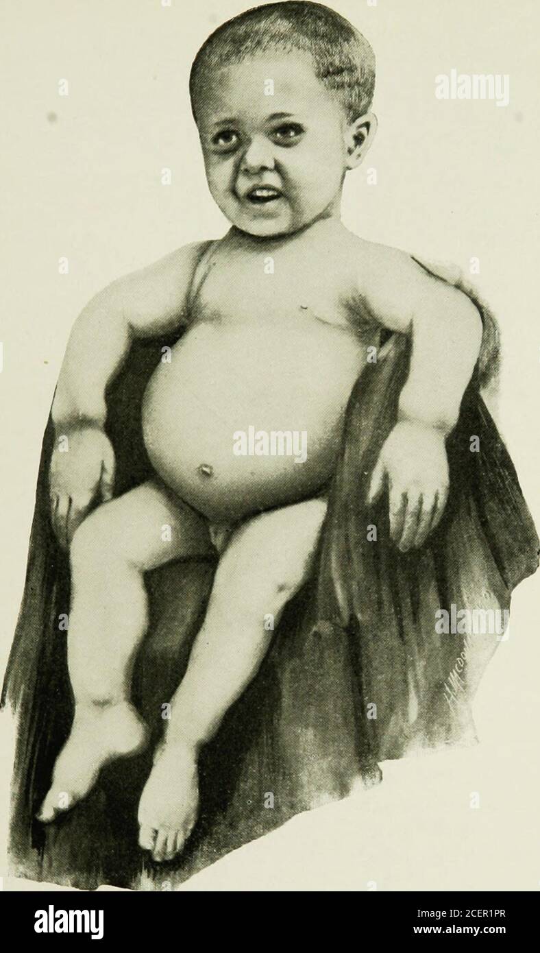 Babies Rasopathy . The diseases of infancy and childhood. born infants,especially the ...
