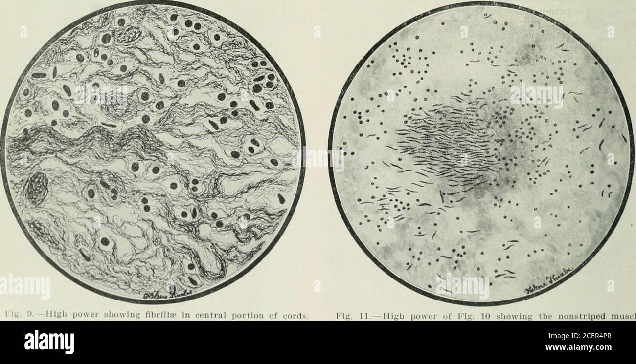 . Journal - American Medical Association. lig. 8.—Shuwiug two vessels with extensive subeudothelial pro-liferation; red cells seen In one lumen; smooth muscle cells. shows brownish, mottled pigmentation. Having the same dis-tribution as the pigmentation are peanut to hazelnut-sizedareas of epidermal thickening, resembling sebaceous warts. The skin of the face hangs in great lobulated folds over thelower jaw and from the orbits on either ^ide (dermatolysis).The lips are onovninusly thirkoiied. The lower eyelids are vblcb is an puwer siiuwing ti-ausverse sfcliunof smooth muscle libers. tortuous Stock Photo