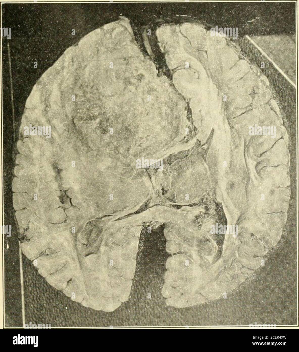 Subcortex High Resolution Stock Photography and Images - Alamy