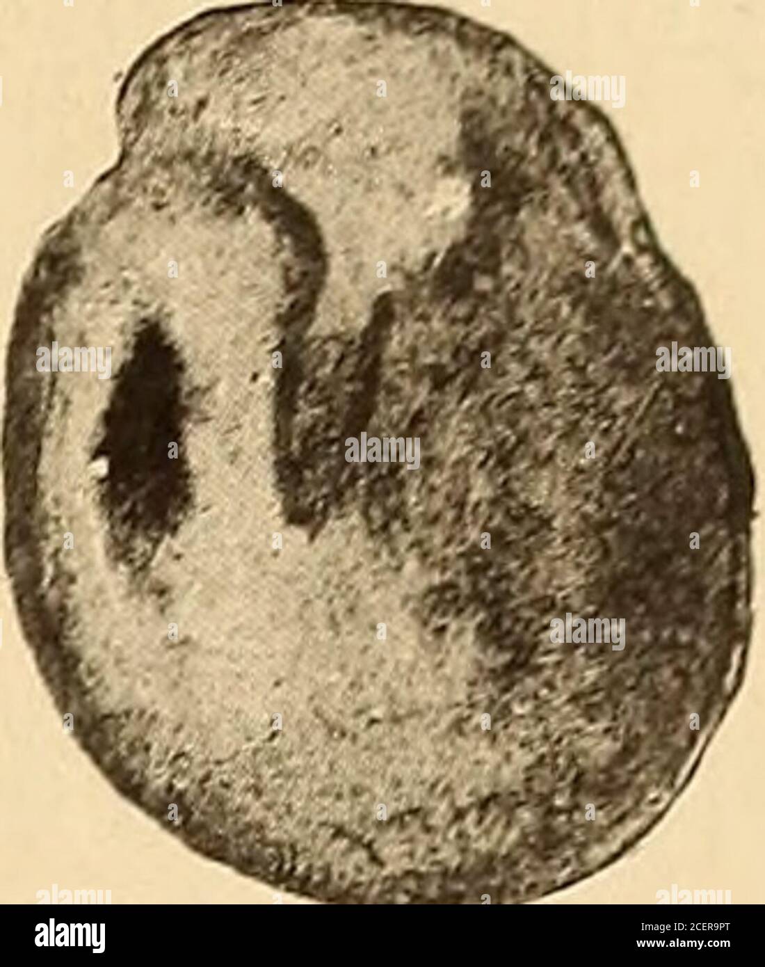 Normal Tympanic Membrane Landmarks