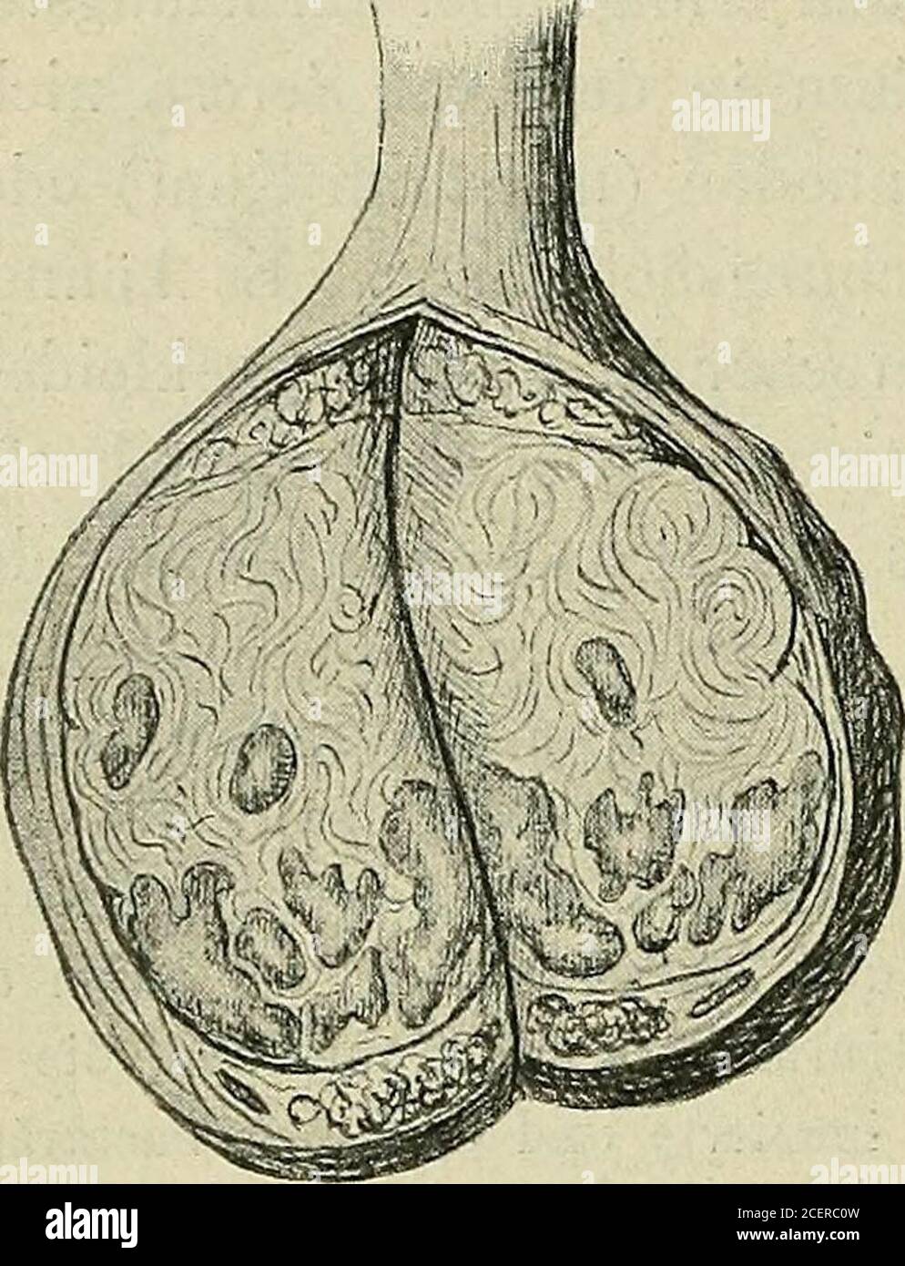 . Lehrbuch der speziellen pathologischen Anatomie für Studierende und Ärzte. sprung zu er-schließen. Der Hoden ist meist nicht vergröi3ert, oft sogar verkleinert undhart, der Nebenhoden meist frei; ß) spezifische, gummöse Orchitis.Am häufigsten bekommt man vorgerückte Stadien schwielig-gummöser Orchitis zu sehen; der vergrößerte, derbe, noch annähernd eiförmige Hoden zeigt auf dem Durch-schnitt in tieischig-schwieligem, blaß-graurotem oder sehnig-weißem Gewebe gelegene,etvras auf der Schnittfläche vorspringende, rundliche oder rundlich-eckige, ausgezackte,manchmal landkartenartig konturierte, Stock Photo