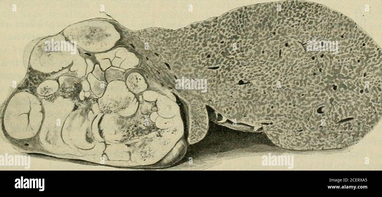 Lehrbuch der speziellen pathologischen Anatomie für Studierende und Ärzte.  die Kapillaren und wachsen von hier aus, das Parenchym zerstörend,weiter.  Das makroskopisch schwarze Pigment, Geschwulstmelanin (S-haltig,  Fe-los),ist mikroskopisch oft ...