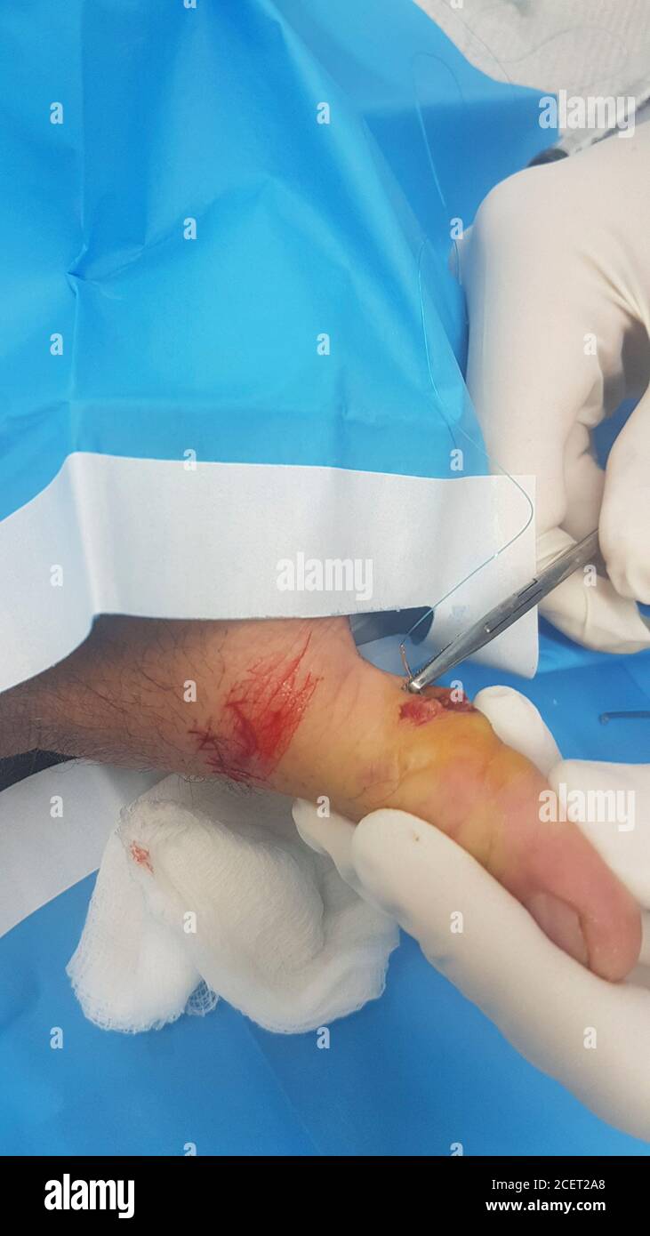 Stitching an injured thumb while using an electric rotary saw the worker injured his thumb on the revolving blade. luckily, the operator was wearing p Stock Photo