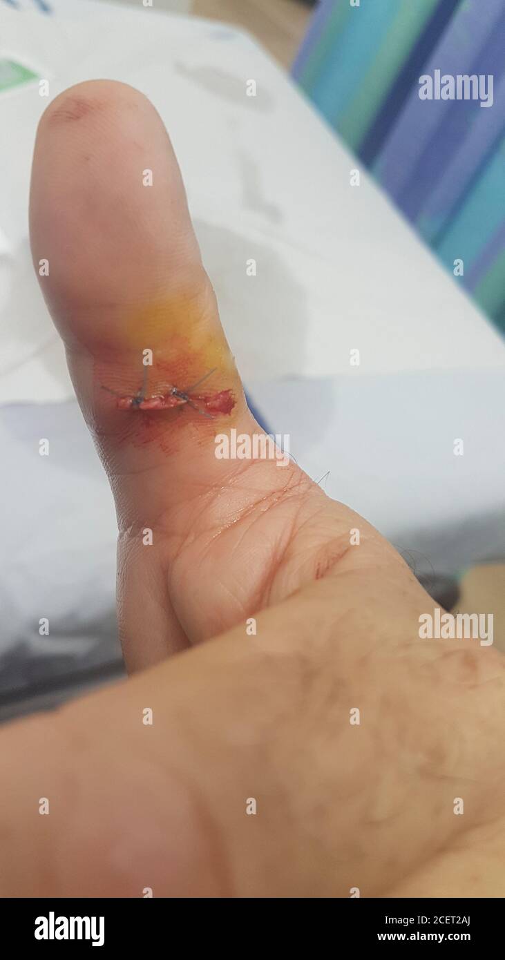 Stitching an injured thumb while using an electric rotary saw the worker injured his thumb on the revolving blade. luckily, the operator was wearing p Stock Photo