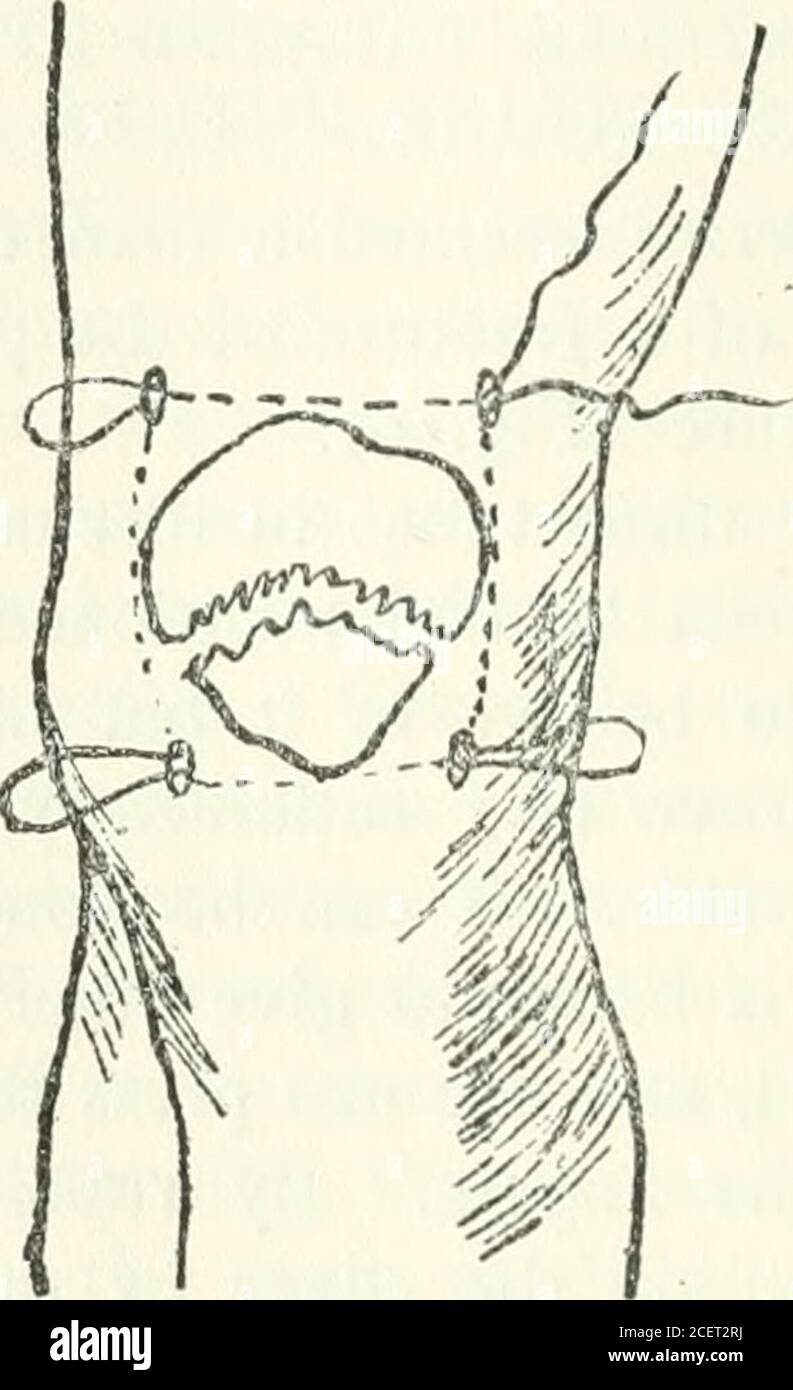 . Annals of surgery. ing suture in the coronal plane,going around the bone by passing through the ligamentumpatellae, catching the tendinomuscular tissues on both sides, andtraversing the muscle just above the bone. It thus, when tied,draws the fragments together. It is satisfactory for a man who 267 268 PHILADELPHIA ACADEMY OF SURGERY. does not like to give his patient too great a risk, and who is notafraid of aseptic subcutaneous work or of the string breaking. It is wise to make four punctures through the skin and deepfasciae at the points of exit of the needle, so that the ligaturewhen tie Stock Photo