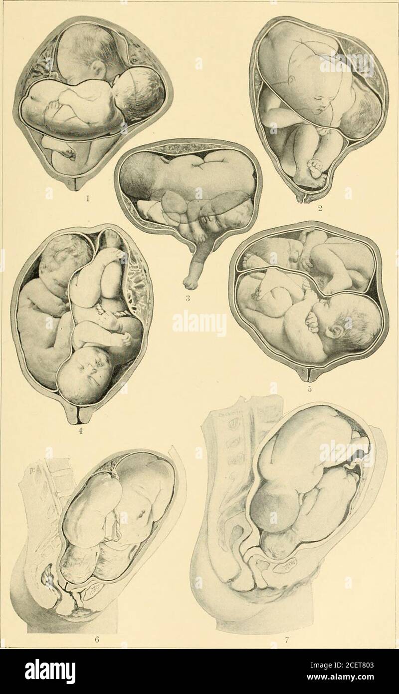 Breech Position Hi Res Stock Photography And Images Page 2 Alamy