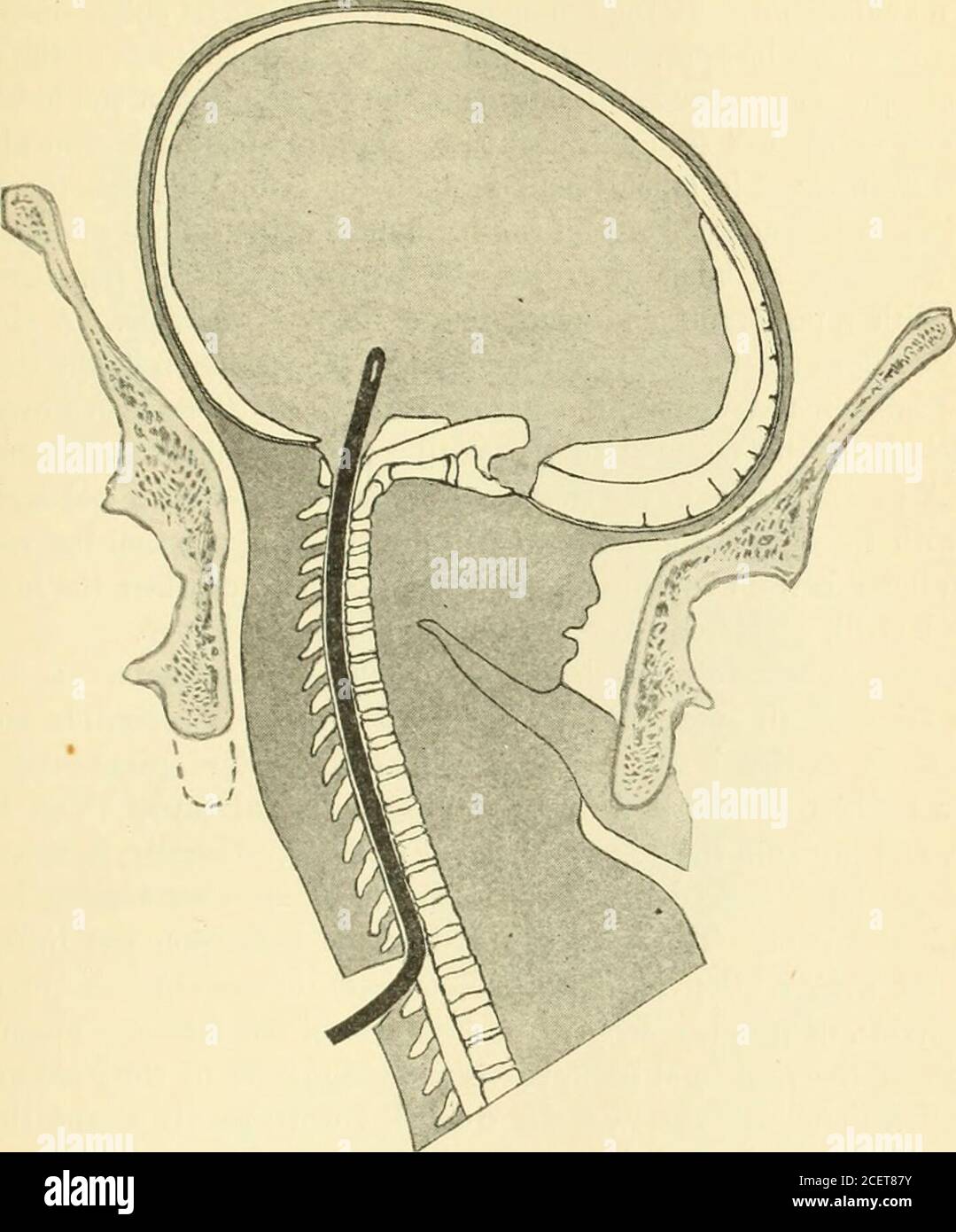 . An American text-book of obstetrics. For practitioners and students. 1. Skeleton of hydrocephalus (Hirst Collection, University of Pennsylvania). 2. Hydrocephalus(Hirst). 3. Hydrencephalocele posterior (Hirst and Piersol). 4. Hydrencephalocele superior. 5. Hydro-cephalus distending lower uterine segment (Varnier). 6. Tapping a hydrocephalus through the spinal canal, DYSTOCIA. 565 its bulk may constitute thereby an obstruction in labor. Cystic tumors, effu-sions in the serous cavities, anasarca, an enlarged liver, polycystic disease ofthe kidneys,24 and distended bladder from atresia of the u Stock Photo
